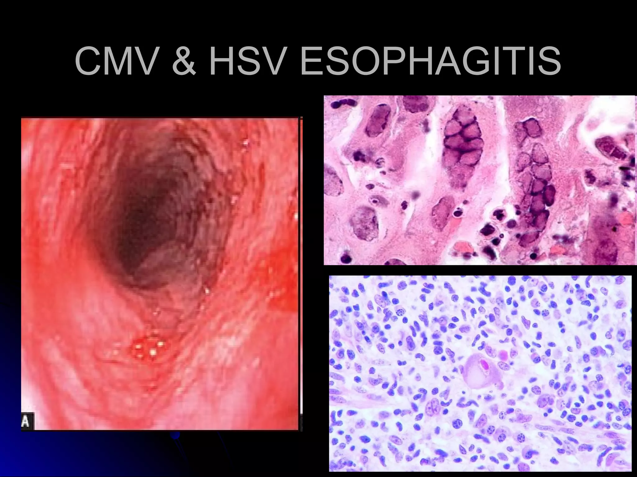 CMV & HSV ESOPHAGITISCMV & HSV ESOPHAGITIS
 