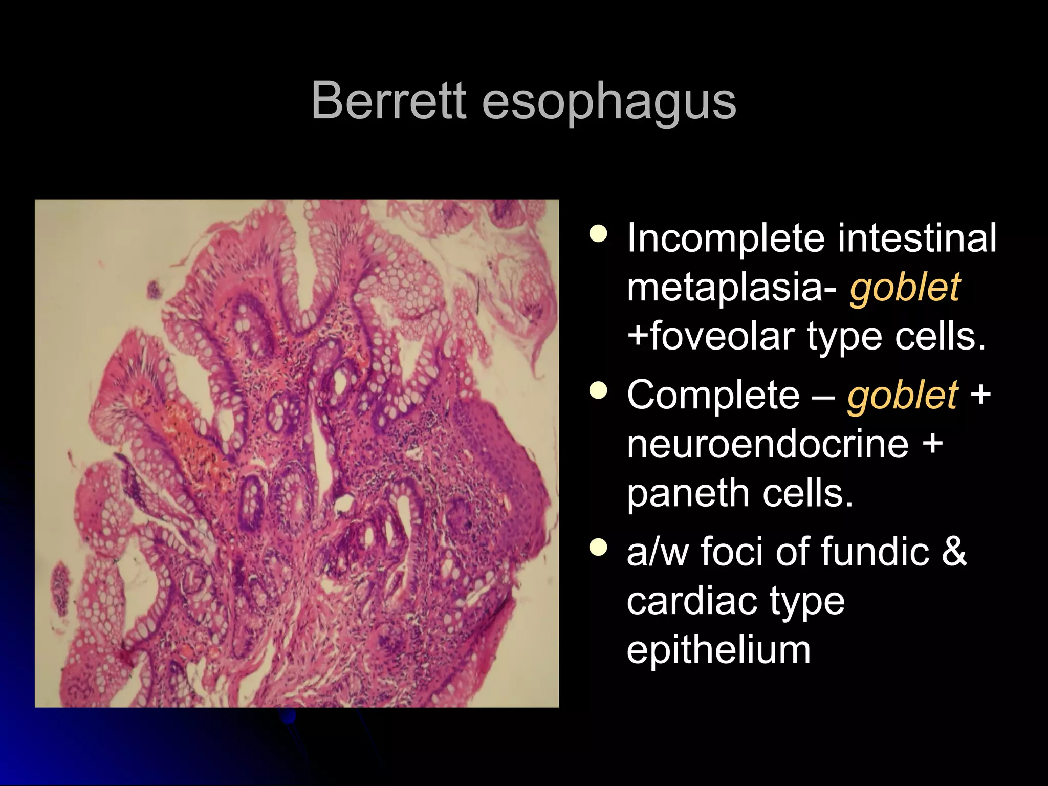 Berrett esophagusBerrett esophagus
 Incomplete intestinalIncomplete intestinal
metaplasia-metaplasia- goblet
+foveolar type cells.+foveolar type cells.
 Complete –Complete – goblet ++
neuroendocrine +neuroendocrine +
paneth cells.paneth cells.
 a/w foci of fundic &a/w foci of fundic &
cardiac typecardiac type
epitheliumepithelium
 