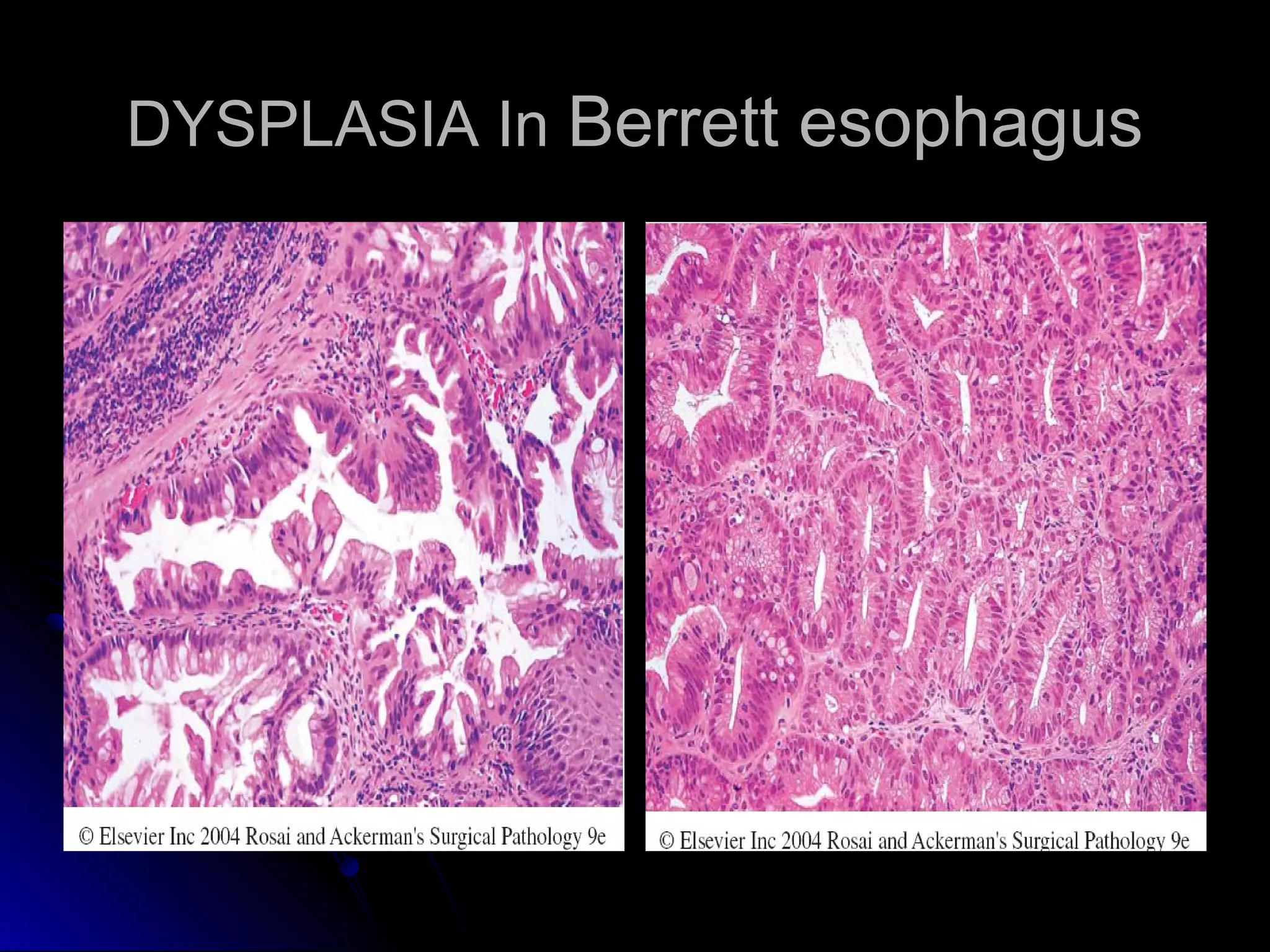 DYSPLASIA InDYSPLASIA In Berrett esophagusBerrett esophagus
 