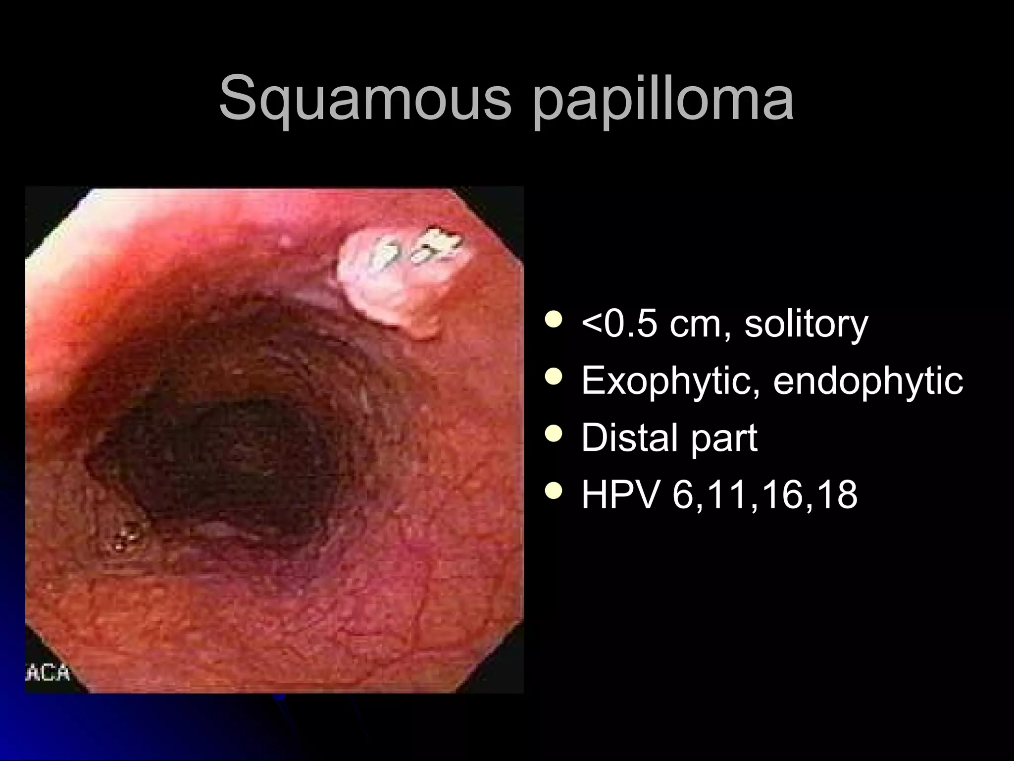Squamous papillomaSquamous papilloma
 <0.5 cm, solitory<0.5 cm, solitory
 Exophytic, endophyticExophytic, endophytic
 Distal partDistal part
 HPV 6,11,16,18HPV 6,11,16,18
 