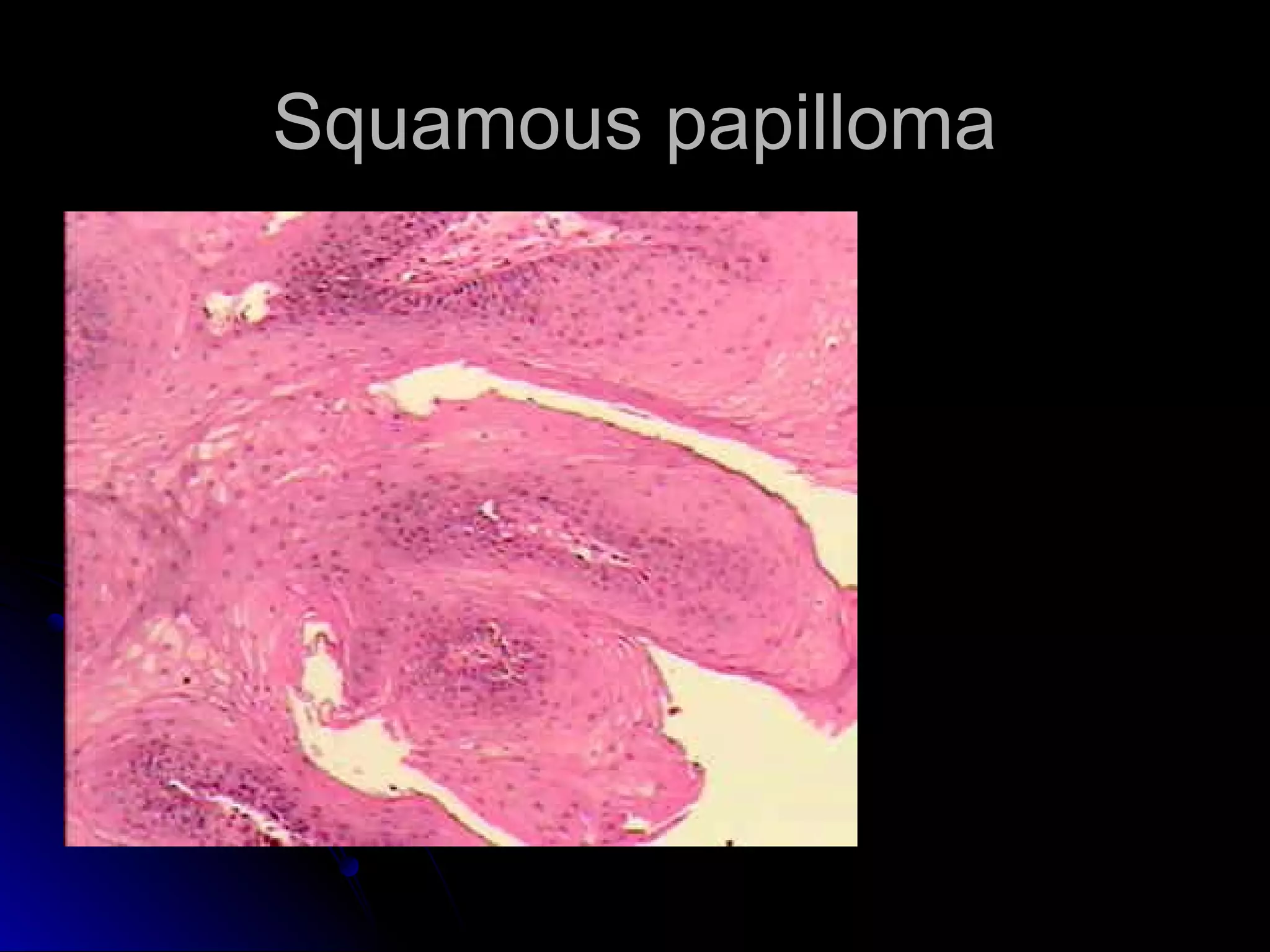 Squamous papillomaSquamous papilloma
 