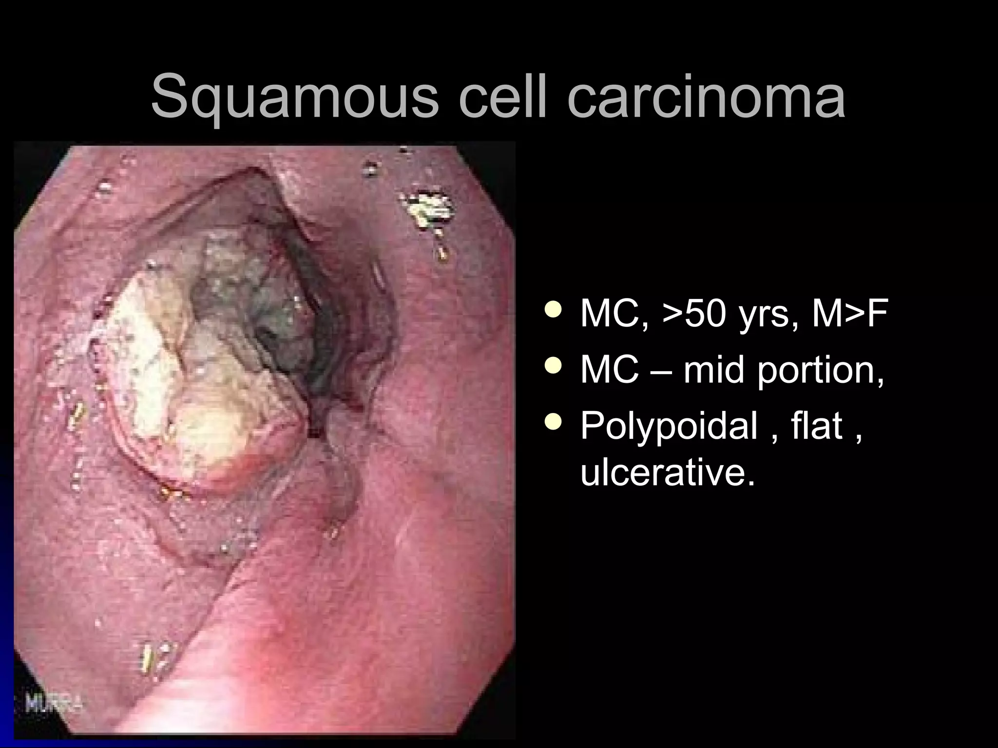 Squamous cell carcinomaSquamous cell carcinoma
 MC, >50 yrs, M>FMC, >50 yrs, M>F
 MC – mid portion,MC – mid portion,
 Polypoidal , flat ,Polypoidal , flat ,
ulcerative.ulcerative.
 