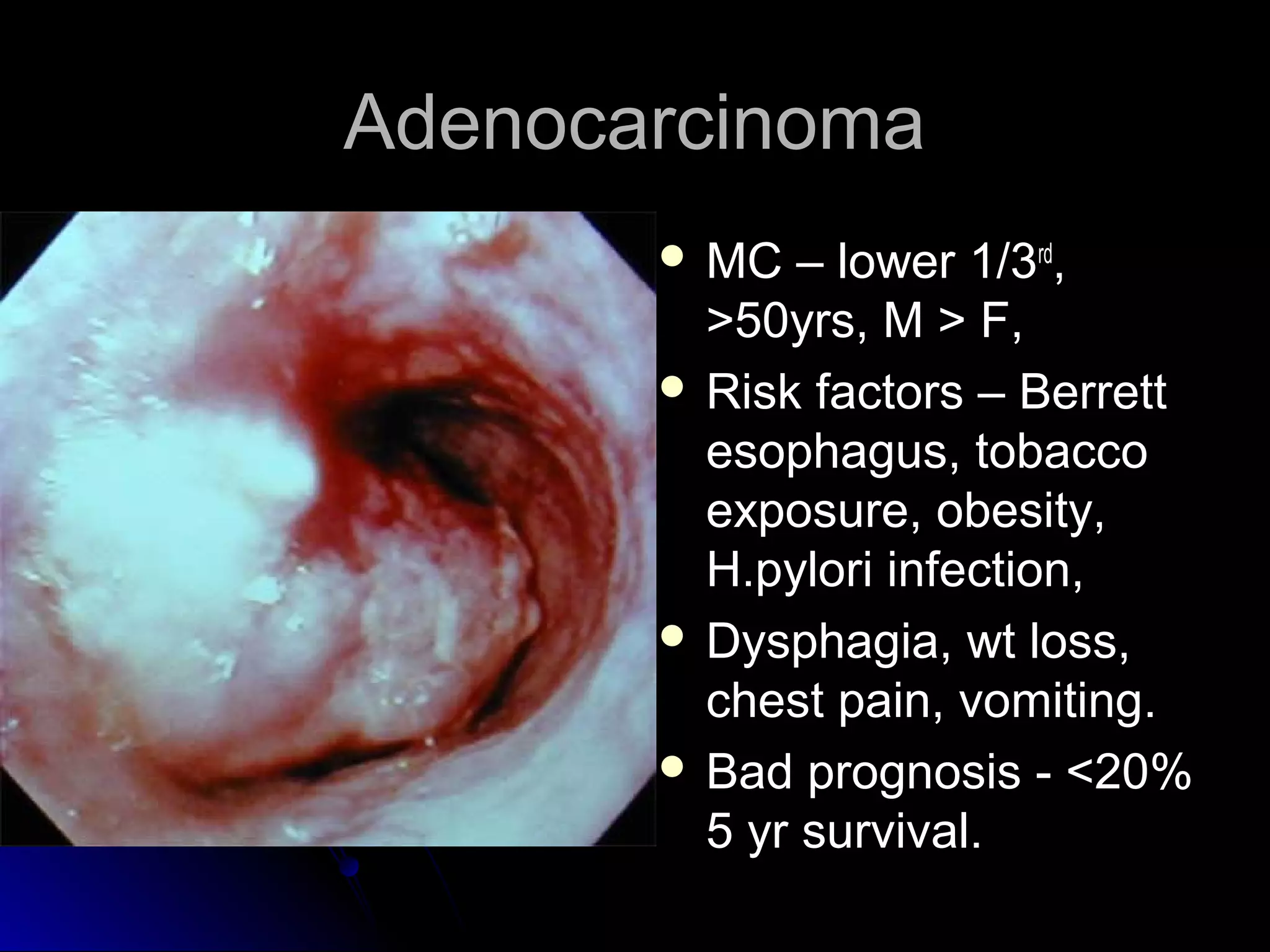 AdenocarcinomaAdenocarcinoma
 MC – lower 1/3MC – lower 1/3rdrd
,,
>50yrs, M > F,>50yrs, M > F,
 Risk factors – BerrettRisk factors – Berrett
esophagus, tobaccoesophagus, tobacco
exposure, obesity,exposure, obesity,
H.pylori infection,H.pylori infection,
 Dysphagia, wt loss,Dysphagia, wt loss,
chest pain, vomiting.chest pain, vomiting.
 Bad prognosis - <20%Bad prognosis - <20%
5 yr survival.5 yr survival.
 