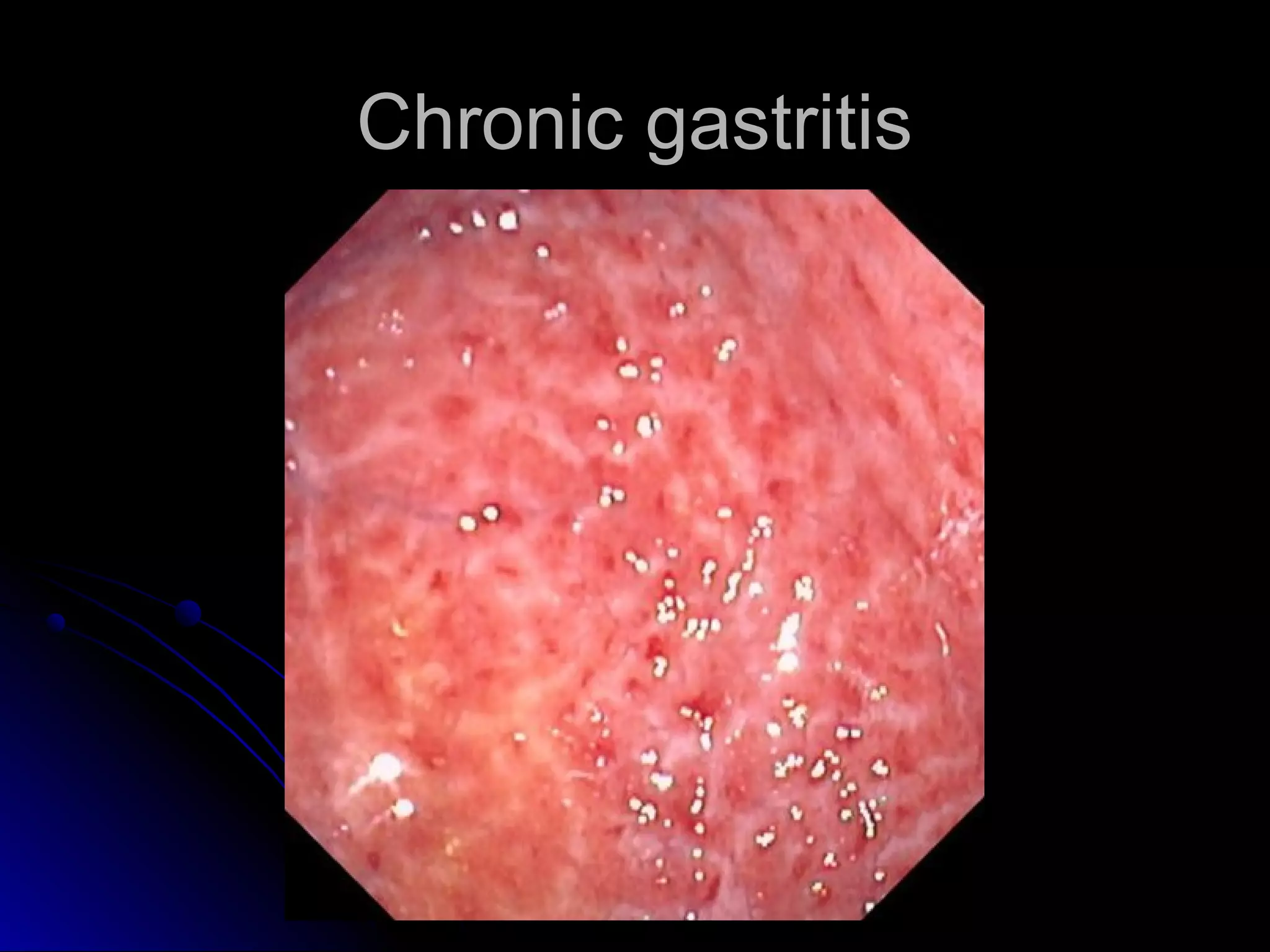 Chronic gastritisChronic gastritis
 