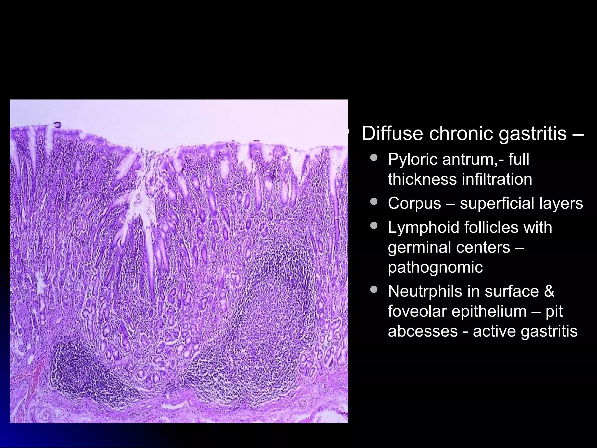  Diffuse chronic gastritis –Diffuse chronic gastritis –
 Pyloric antrum,- fullPyloric antrum,- full
thickness infiltrationthickness infiltration
 Corpus – superficial layersCorpus – superficial layers
 Lymphoid follicles withLymphoid follicles with
germinal centers –germinal centers –
pathognomicpathognomic
 Neutrphils in surface &Neutrphils in surface &
foveolar epithelium – pitfoveolar epithelium – pit
abcesses - active gastritisabcesses - active gastritis
 