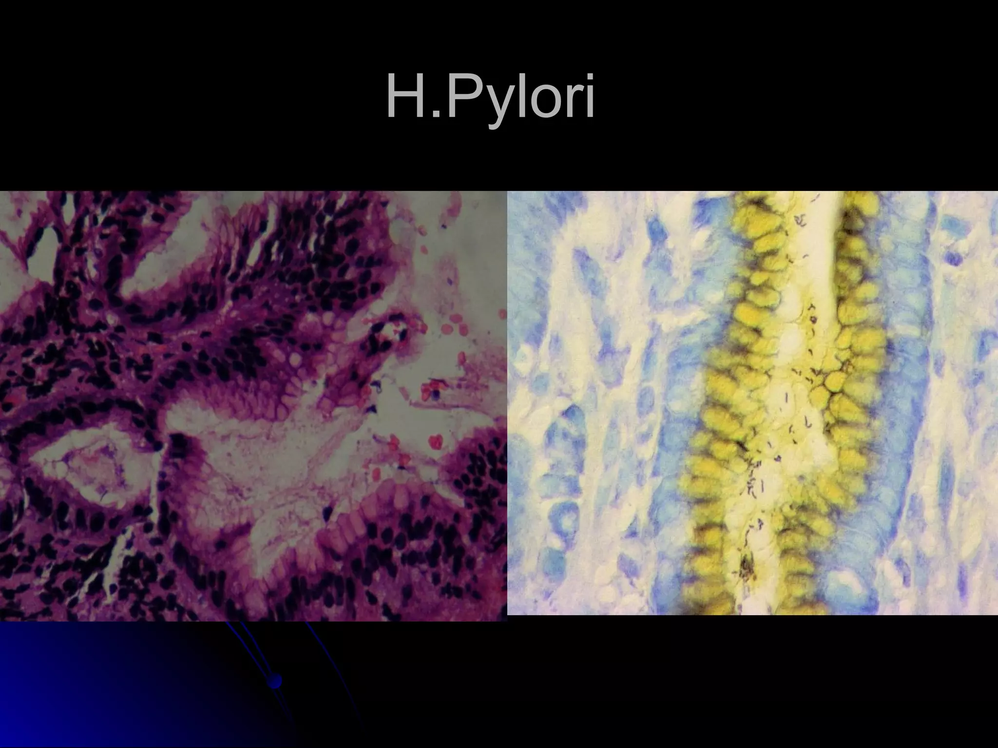 H.PyloriH.Pylori
 