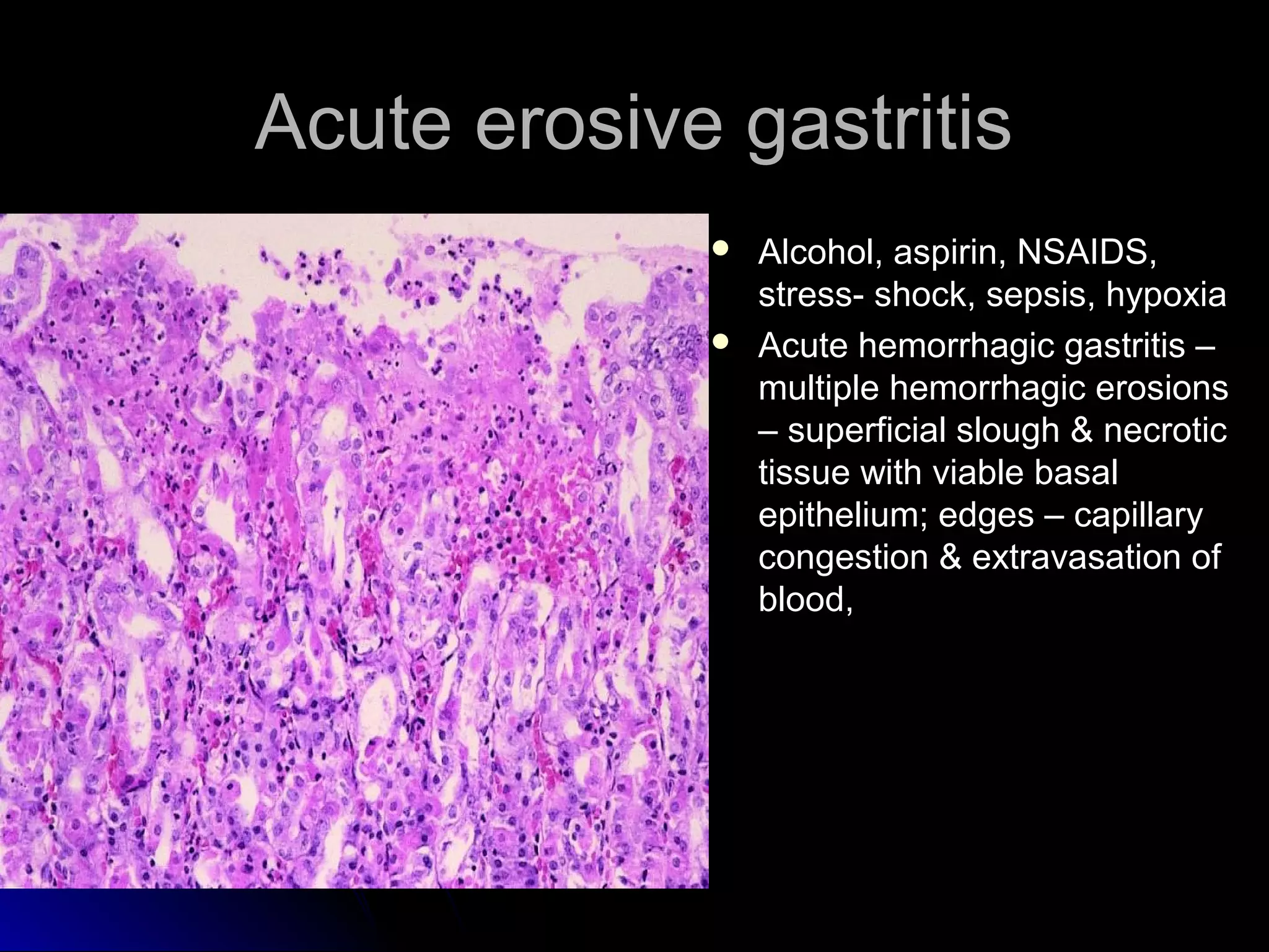 Acute erosive gastritisAcute erosive gastritis
 Alcohol, aspirin, NSAIDS,Alcohol, aspirin, NSAIDS,
stress- shock, sepsis, hypoxiastress- shock, sepsis, hypoxia
 Acute hemorrhagic gastritis –Acute hemorrhagic gastritis –
multiple hemorrhagic erosionsmultiple hemorrhagic erosions
– superficial slough & necrotic– superficial slough & necrotic
tissue with viable basaltissue with viable basal
epithelium; edges – capillaryepithelium; edges – capillary
congestion & extravasation ofcongestion & extravasation of
blood,blood,
 