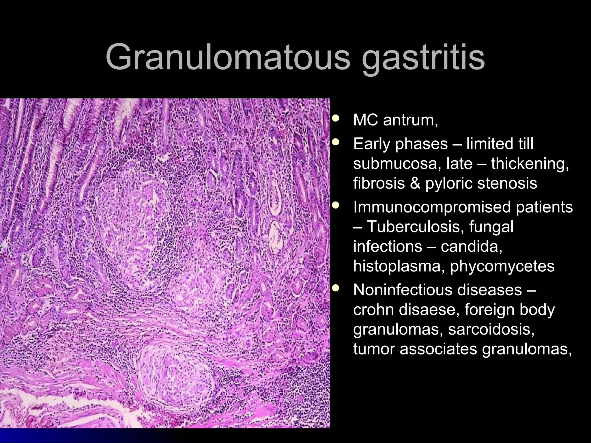 Granulomatous gastritisGranulomatous gastritis
 MC antrum,MC antrum,
 Early phases – limited tillEarly phases – limited till
submucosa, late – thickening,submucosa, late – thickening,
fibrosis & pyloric stenosisfibrosis & pyloric stenosis
 Immunocompromised patientsImmunocompromised patients
– Tuberculosis, fungal– Tuberculosis, fungal
infections – candida,infections – candida,
histoplasma, phycomyceteshistoplasma, phycomycetes
 Noninfectious diseases –Noninfectious diseases –
crohn disaese, foreign bodycrohn disaese, foreign body
granulomas, sarcoidosis,granulomas, sarcoidosis,
tumor associates granulomas,tumor associates granulomas,
 