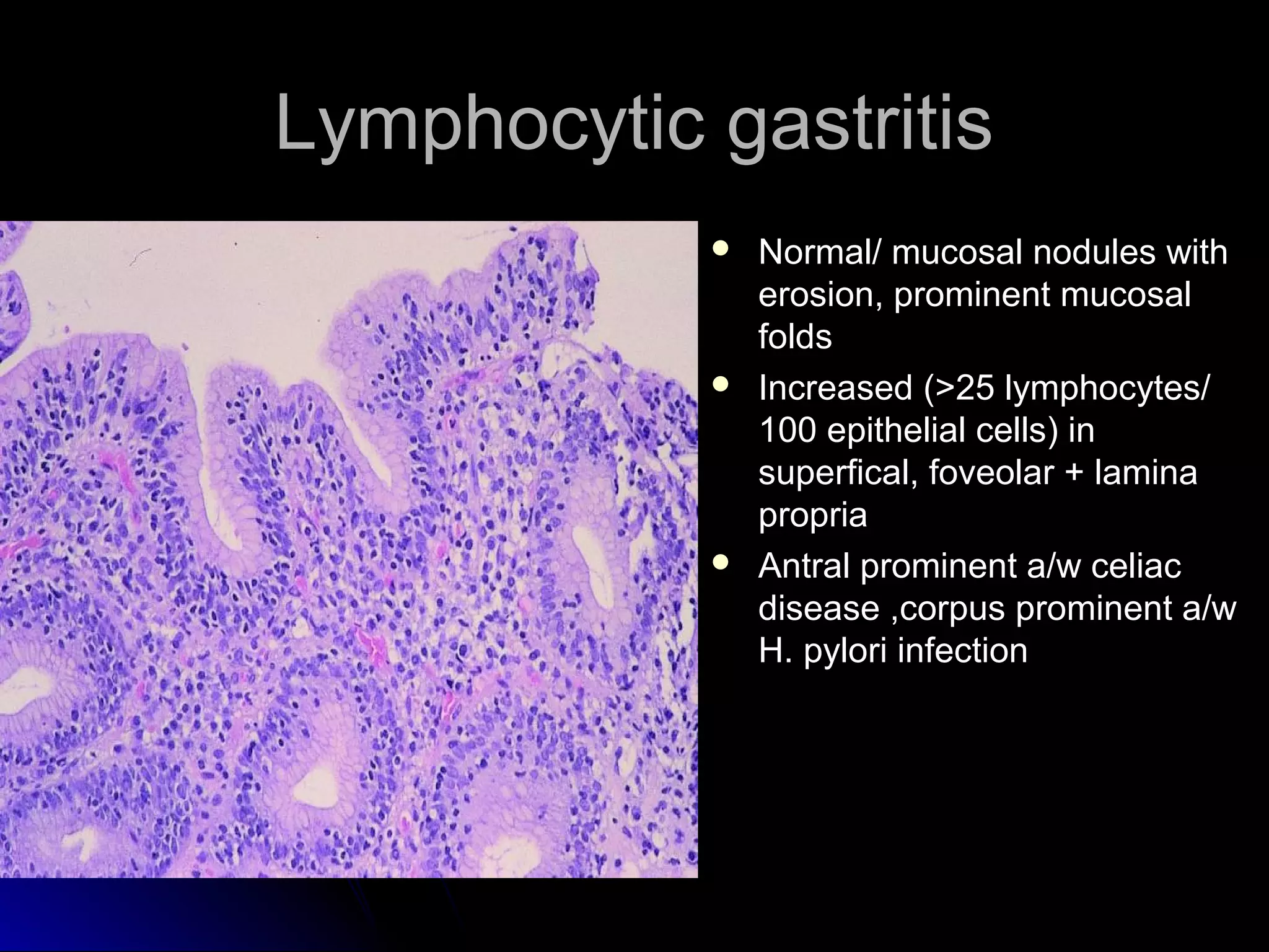 Lymphocytic gastritisLymphocytic gastritis
 Normal/ mucosal nodules withNormal/ mucosal nodules with
erosion, prominent mucosalerosion, prominent mucosal
foldsfolds
 Increased (>25 lymphocytes/Increased (>25 lymphocytes/
100 epithelial cells) in100 epithelial cells) in
superfical, foveolar + laminasuperfical, foveolar + lamina
propriapropria
 Antral prominent a/w celiacAntral prominent a/w celiac
disease ,corpus prominent a/wdisease ,corpus prominent a/w
H. pylori infectionH. pylori infection
 
