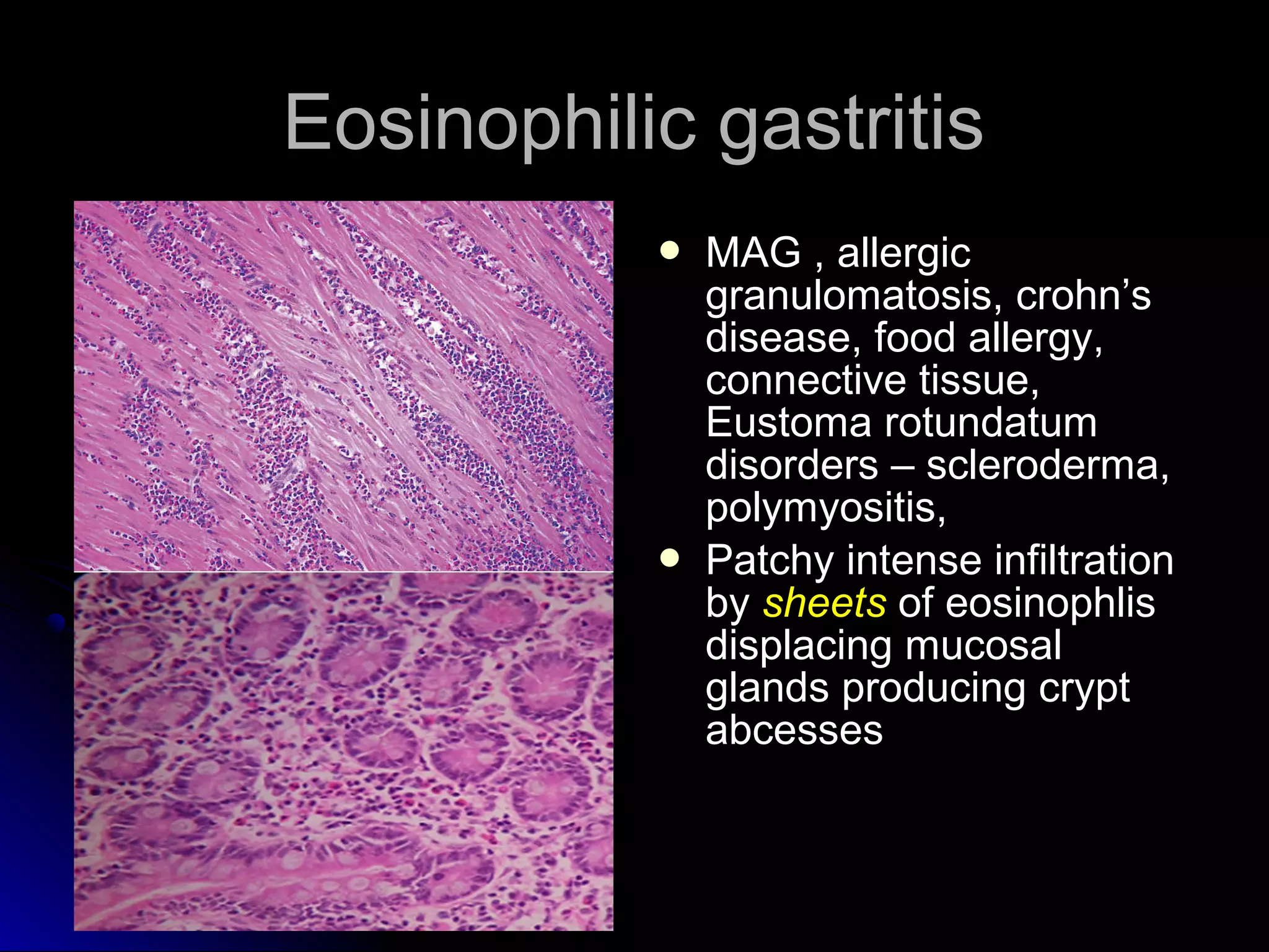 Eosinophilic gastritisEosinophilic gastritis
 MAG , allergicMAG , allergic
granulomatosis, crohn’sgranulomatosis, crohn’s
disease, food allergy,disease, food allergy,
connective tissue,connective tissue,
Eustoma rotundatumEustoma rotundatum
disorders – scleroderma,disorders – scleroderma,
polymyositis,polymyositis,
 Patchy intense infiltrationPatchy intense infiltration
byby sheetssheets of eosinophlisof eosinophlis
displacing mucosaldisplacing mucosal
glands producing cryptglands producing crypt
abcessesabcesses
 