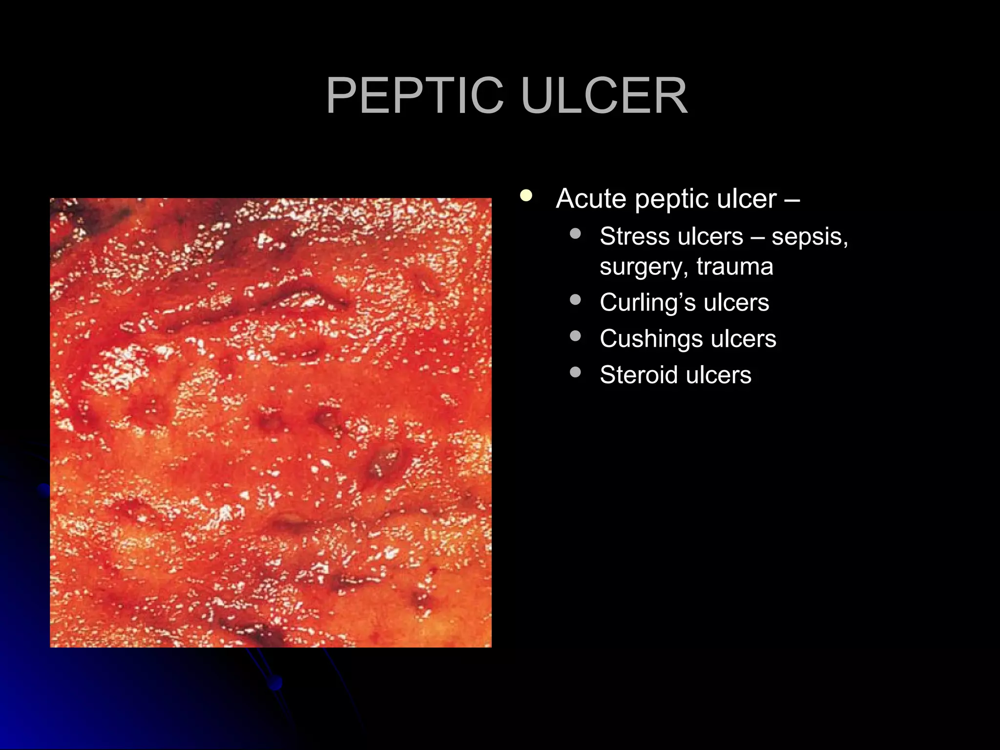 PEPTIC ULCERPEPTIC ULCER
 Acute peptic ulcer –Acute peptic ulcer –
 Stress ulcers – sepsis,Stress ulcers – sepsis,
surgery, traumasurgery, trauma
 Curling’s ulcersCurling’s ulcers
 Cushings ulcersCushings ulcers
 Steroid ulcersSteroid ulcers
 