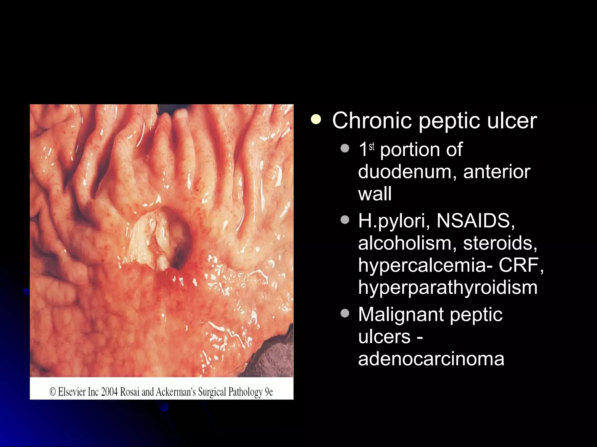  Chronic peptic ulcerChronic peptic ulcer
 11stst
portion ofportion of
duodenum, anteriorduodenum, anterior
wallwall
 H.pylori, NSAIDS,H.pylori, NSAIDS,
alcoholism, steroids,alcoholism, steroids,
hypercalcemia- CRF,hypercalcemia- CRF,
hyperparathyroidismhyperparathyroidism
 Malignant pepticMalignant peptic
ulcers -ulcers -
adenocarcinomaadenocarcinoma
 