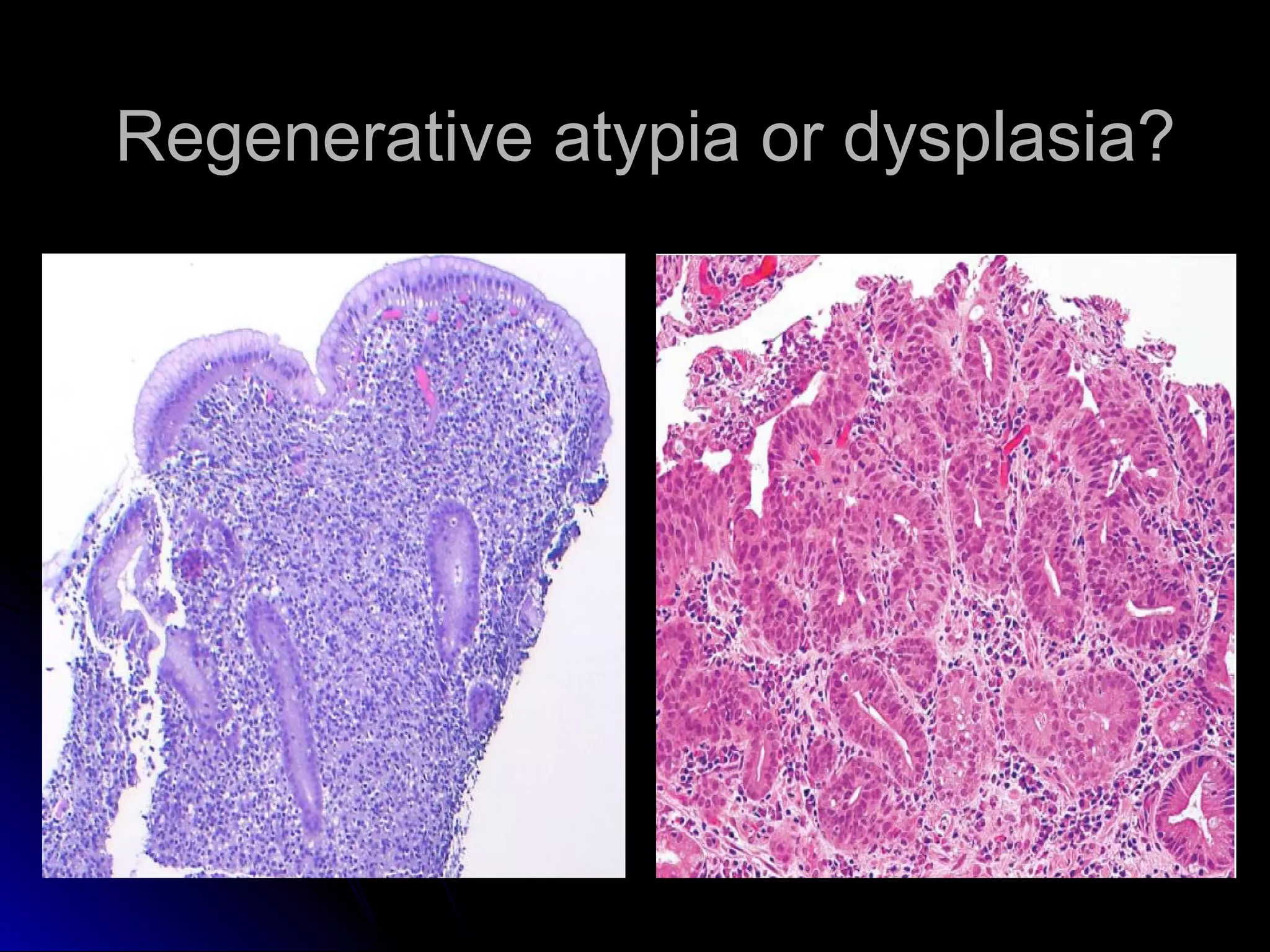 Regenerative atypia or dysplasia?Regenerative atypia or dysplasia?
 