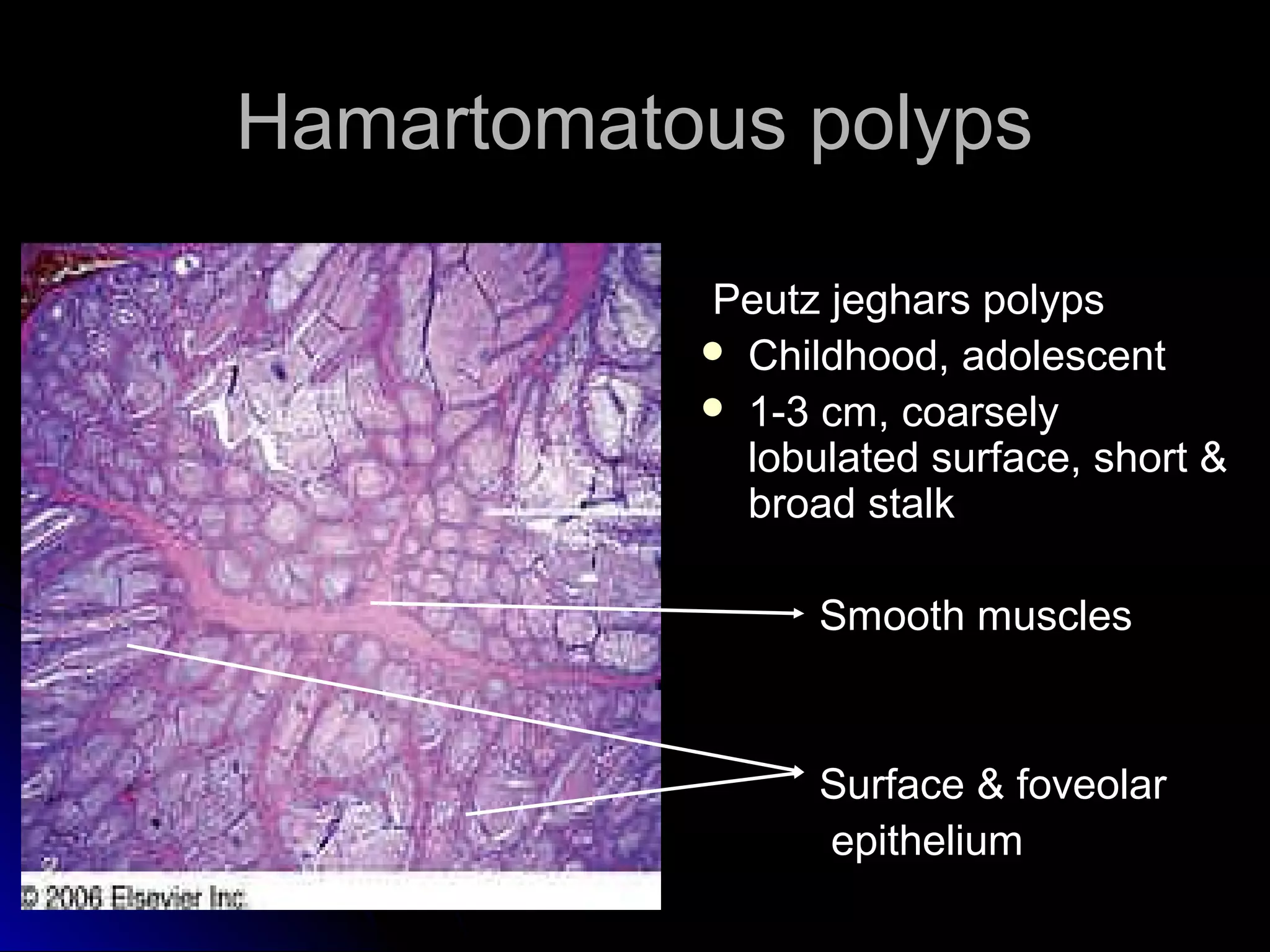 Hamartomatous polypsHamartomatous polyps
Peutz jeghars polypsPeutz jeghars polyps
 Childhood, adolescentChildhood, adolescent
 1-3 cm, coarsely1-3 cm, coarsely
lobulated surface, short &lobulated surface, short &
broad stalkbroad stalk
Smooth musclesSmooth muscles
Surface & foveolarSurface & foveolar
epitheliumepithelium
 