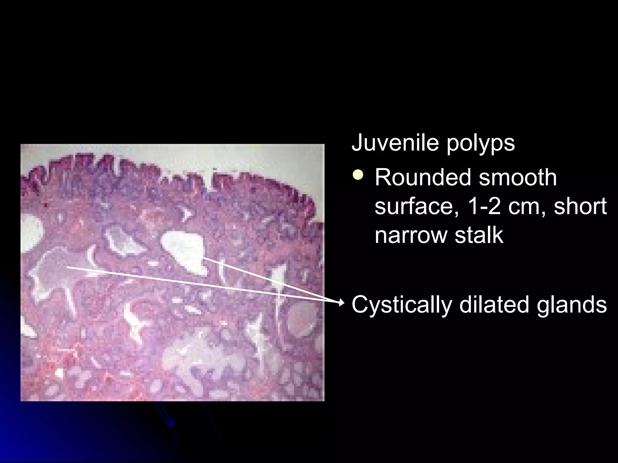 Juvenile polypsJuvenile polyps
 Rounded smoothRounded smooth
surface, 1-2 cm, shortsurface, 1-2 cm, short
narrow stalknarrow stalk
Cystically dilated glandsCystically dilated glands
 