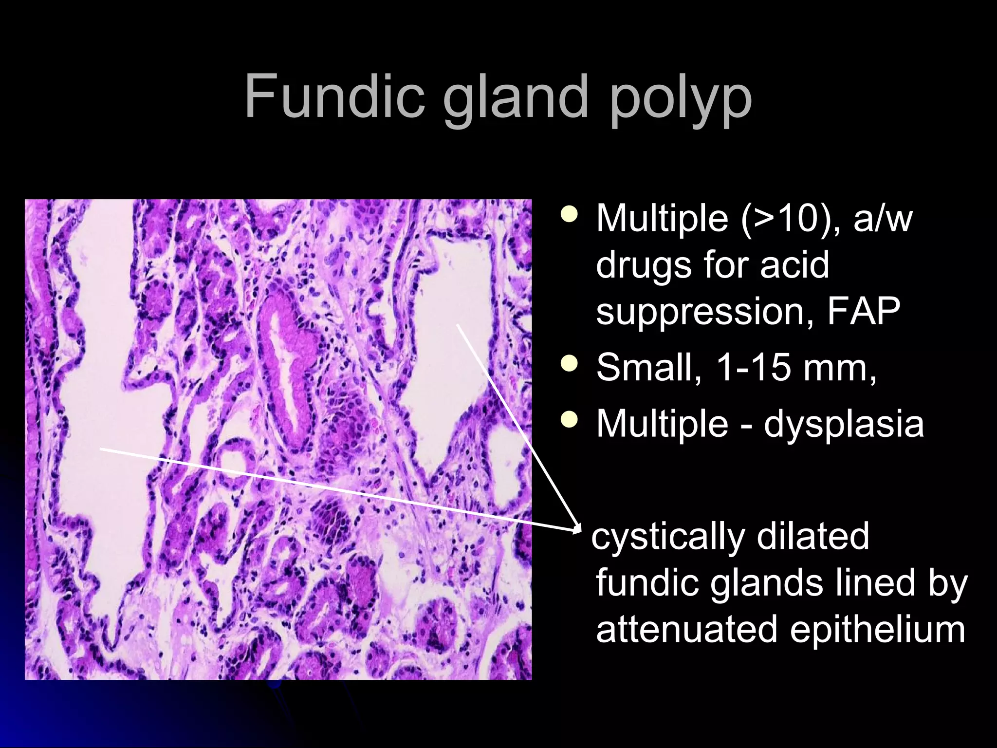 Fundic gland polypFundic gland polyp
 Multiple (>10), a/wMultiple (>10), a/w
drugs for aciddrugs for acid
suppression, FAPsuppression, FAP
 Small, 1-15 mm,Small, 1-15 mm,
 Multiple - dysplasiaMultiple - dysplasia
cystically dilatedcystically dilated
fundic glands lined byfundic glands lined by
attenuated epitheliumattenuated epithelium
 