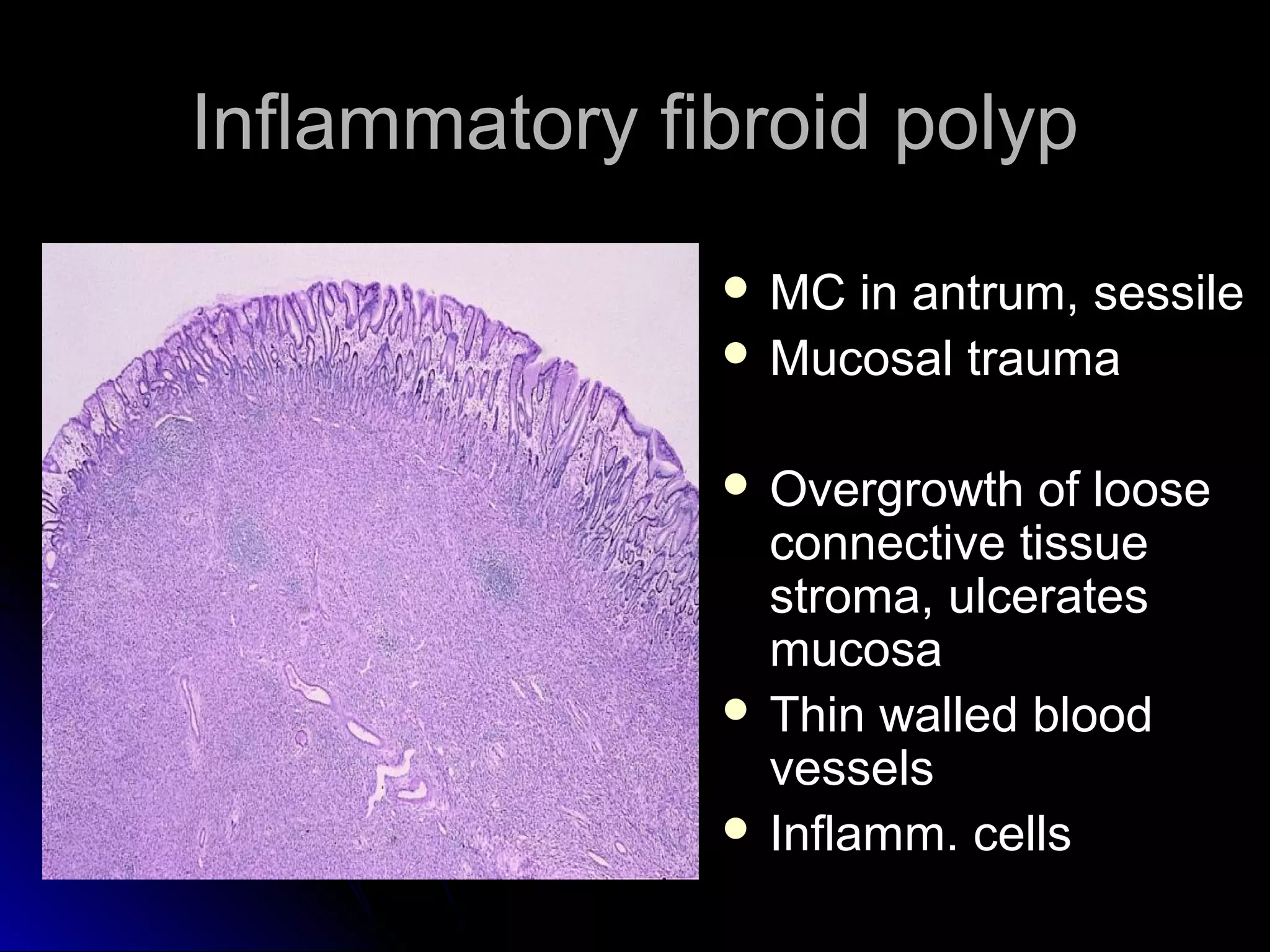 Inflammatory fibroid polypInflammatory fibroid polyp
 MC in antrum, sessileMC in antrum, sessile
 Mucosal traumaMucosal trauma
 Overgrowth of looseOvergrowth of loose
connective tissueconnective tissue
stroma, ulceratesstroma, ulcerates
mucosamucosa
 Thin walled bloodThin walled blood
vesselsvessels
 Inflamm. cellsInflamm. cells
 