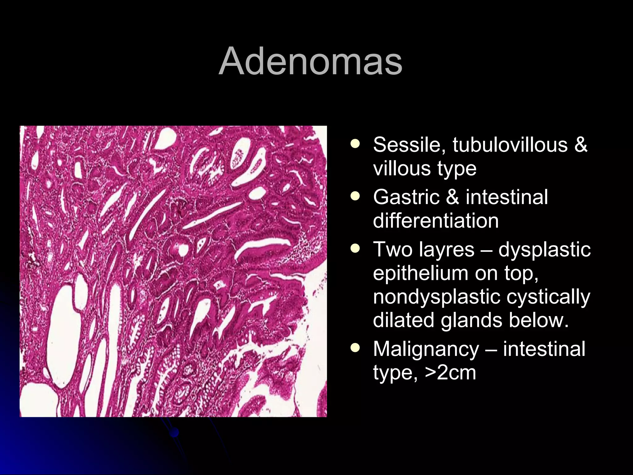 AdenomasAdenomas
 Sessile, tubulovillous &Sessile, tubulovillous &
villous typevillous type
 Gastric & intestinalGastric & intestinal
differentiationdifferentiation
 Two layres – dysplasticTwo layres – dysplastic
epithelium on top,epithelium on top,
nondysplastic cysticallynondysplastic cystically
dilated glands below.dilated glands below.
 Malignancy – intestinalMalignancy – intestinal
type, >2cmtype, >2cm
 