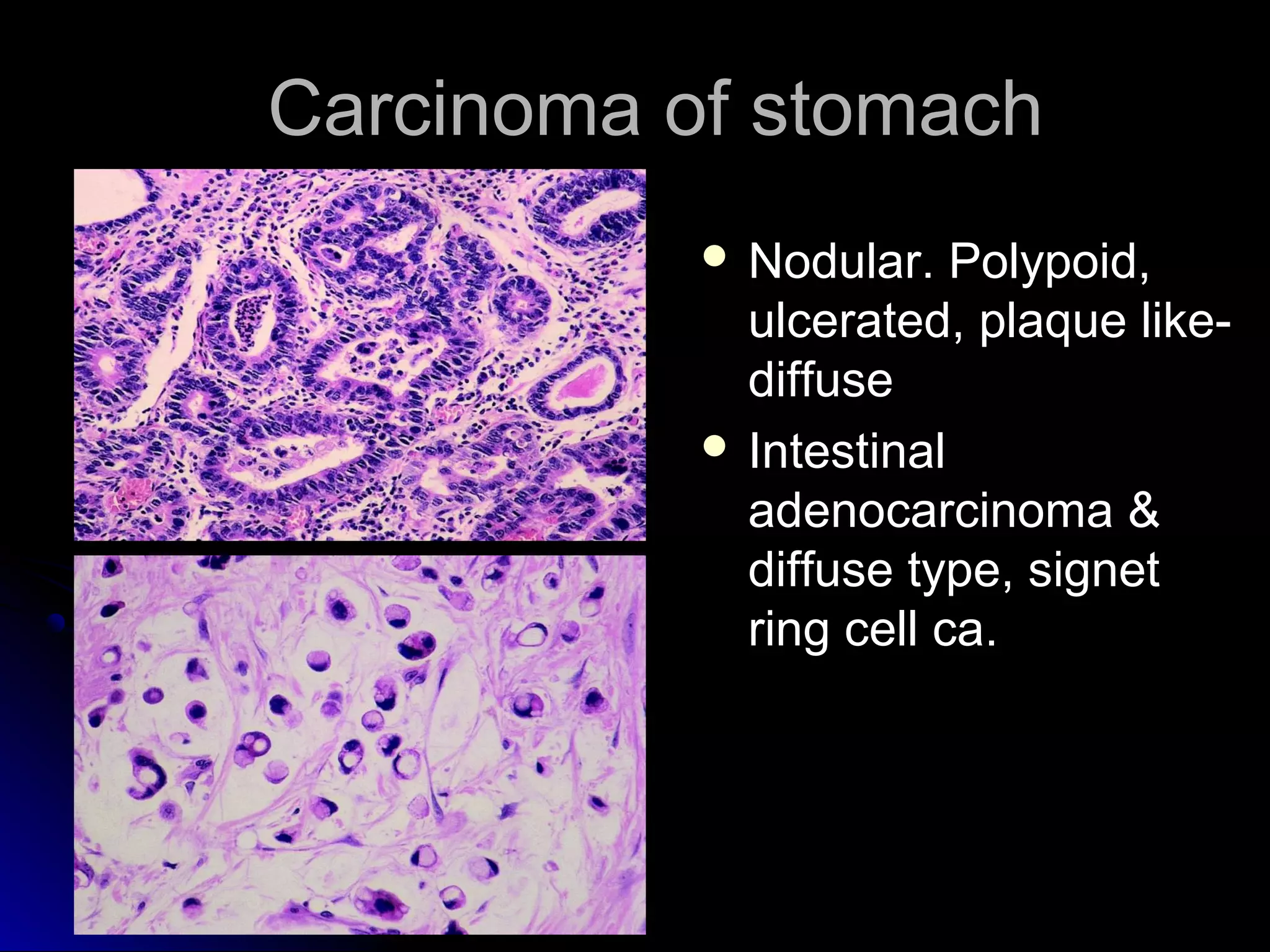Carcinoma of stomachCarcinoma of stomach
 Nodular. Polypoid,Nodular. Polypoid,
ulcerated, plaque like-ulcerated, plaque like-
diffusediffuse
 IntestinalIntestinal
adenocarcinoma &adenocarcinoma &
diffuse type, signetdiffuse type, signet
ring cell ca.ring cell ca.
 