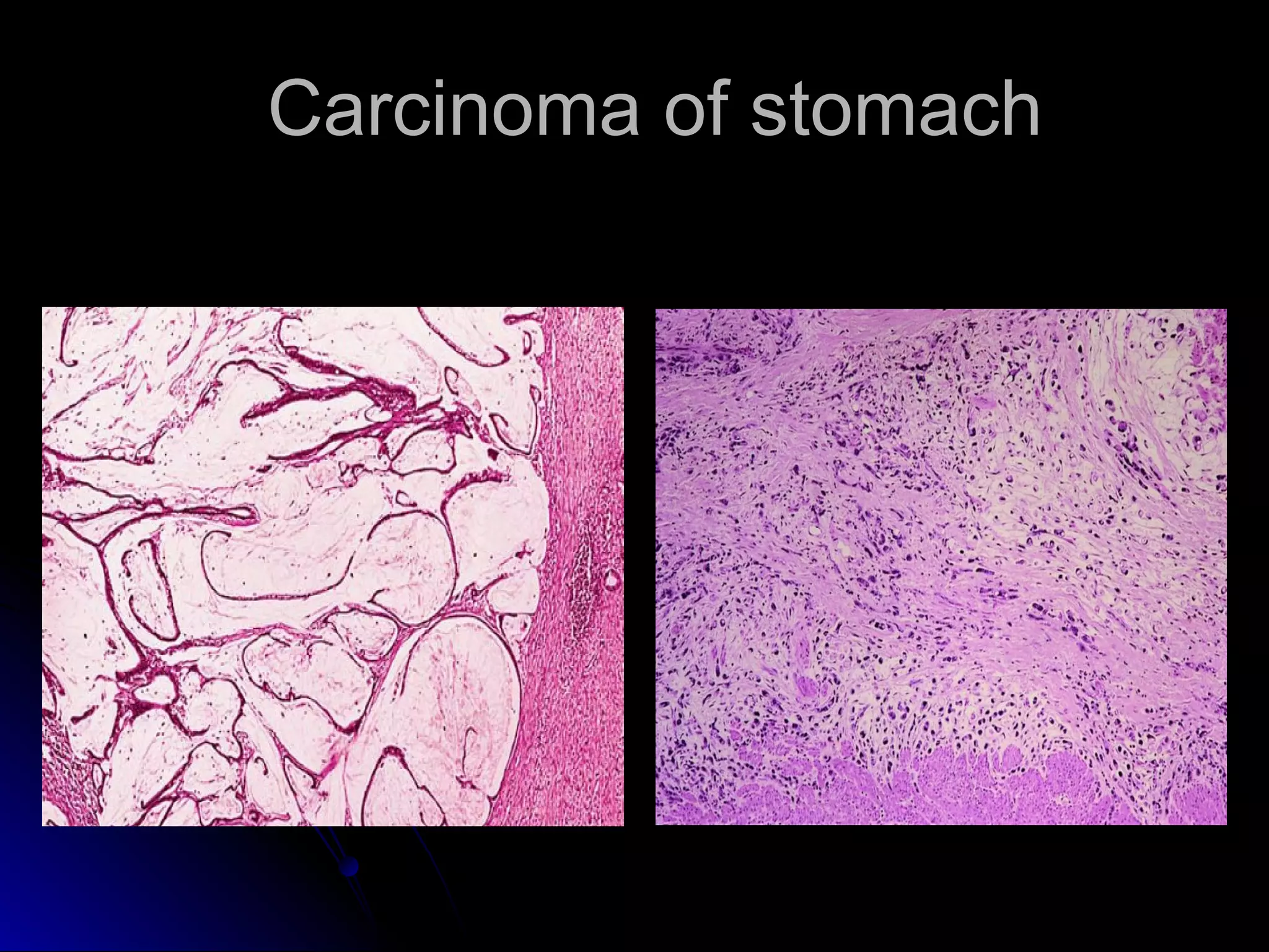 Carcinoma of stomachCarcinoma of stomach
 