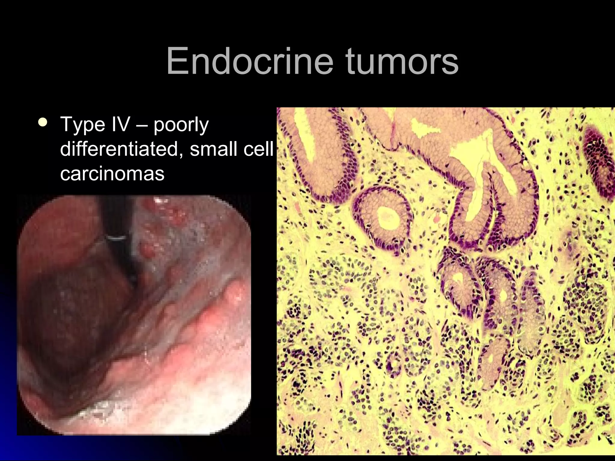  Type IV – poorlyType IV – poorly
differentiated, small celldifferentiated, small cell
carcinomascarcinomas
Endocrine tumorsEndocrine tumors
 