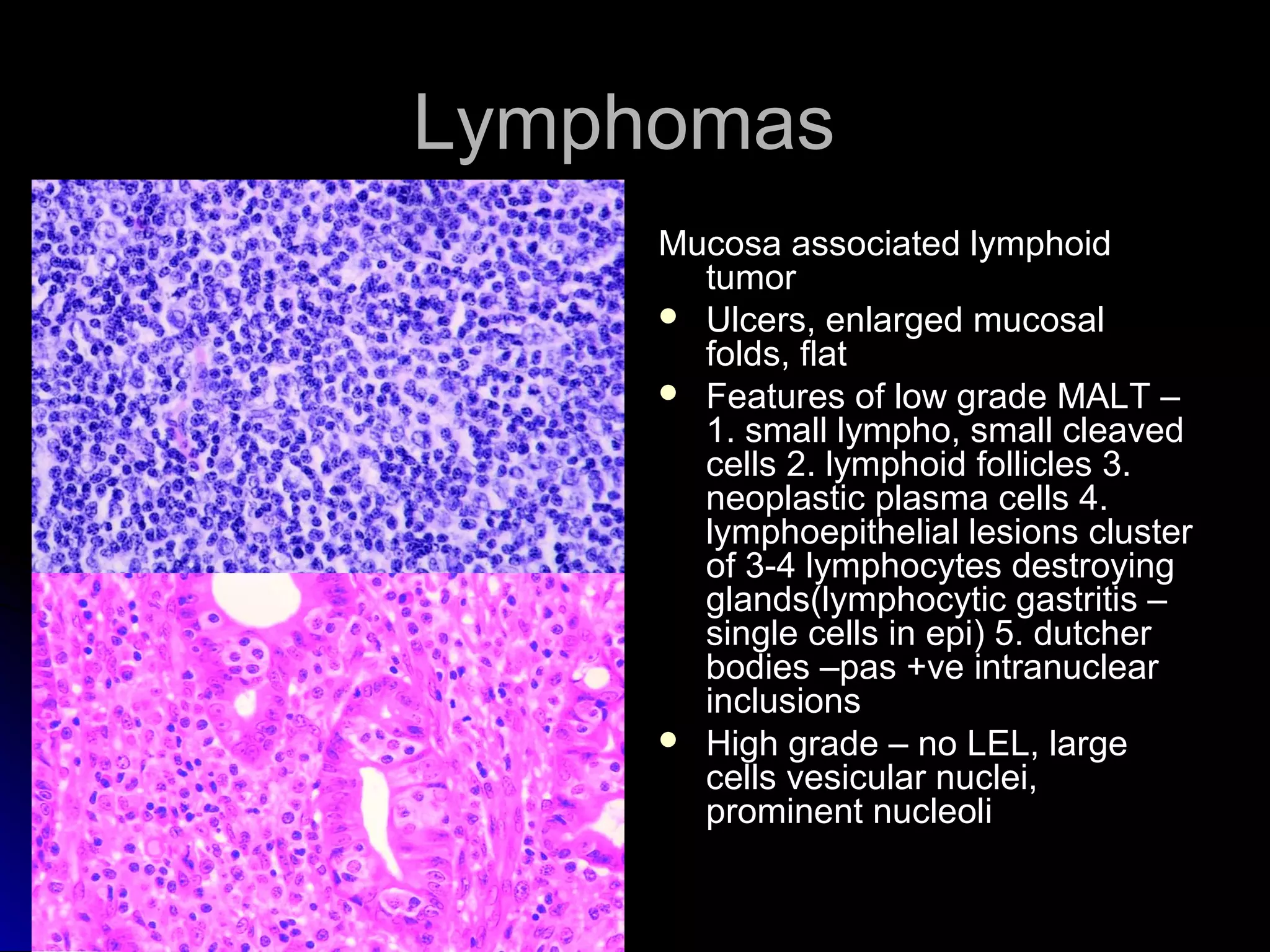 LymphomasLymphomas
Mucosa associated lymphoidMucosa associated lymphoid
tumortumor
 Ulcers, enlarged mucosalUlcers, enlarged mucosal
folds, flatfolds, flat
 Features of low grade MALT –Features of low grade MALT –
1. small lympho, small cleaved1. small lympho, small cleaved
cells 2. lymphoid follicles 3.cells 2. lymphoid follicles 3.
neoplastic plasma cells 4.neoplastic plasma cells 4.
lymphoepithelial lesions clusterlymphoepithelial lesions cluster
of 3-4 lymphocytes destroyingof 3-4 lymphocytes destroying
glands(lymphocytic gastritis –glands(lymphocytic gastritis –
single cells in epi) 5. dutchersingle cells in epi) 5. dutcher
bodies –pas +ve intranuclearbodies –pas +ve intranuclear
inclusionsinclusions
 High grade – no LEL, largeHigh grade – no LEL, large
cells vesicular nuclei,cells vesicular nuclei,
prominent nucleoliprominent nucleoli
 