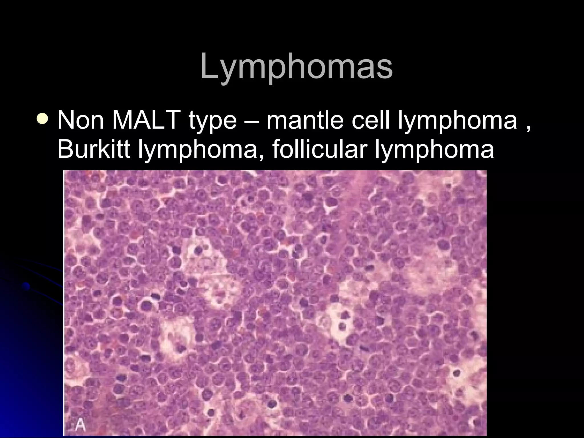  Non MALT type – mantle cell lymphoma ,Non MALT type – mantle cell lymphoma ,
Burkitt lymphoma, follicular lymphomaBurkitt lymphoma, follicular lymphoma
LymphomasLymphomas
 