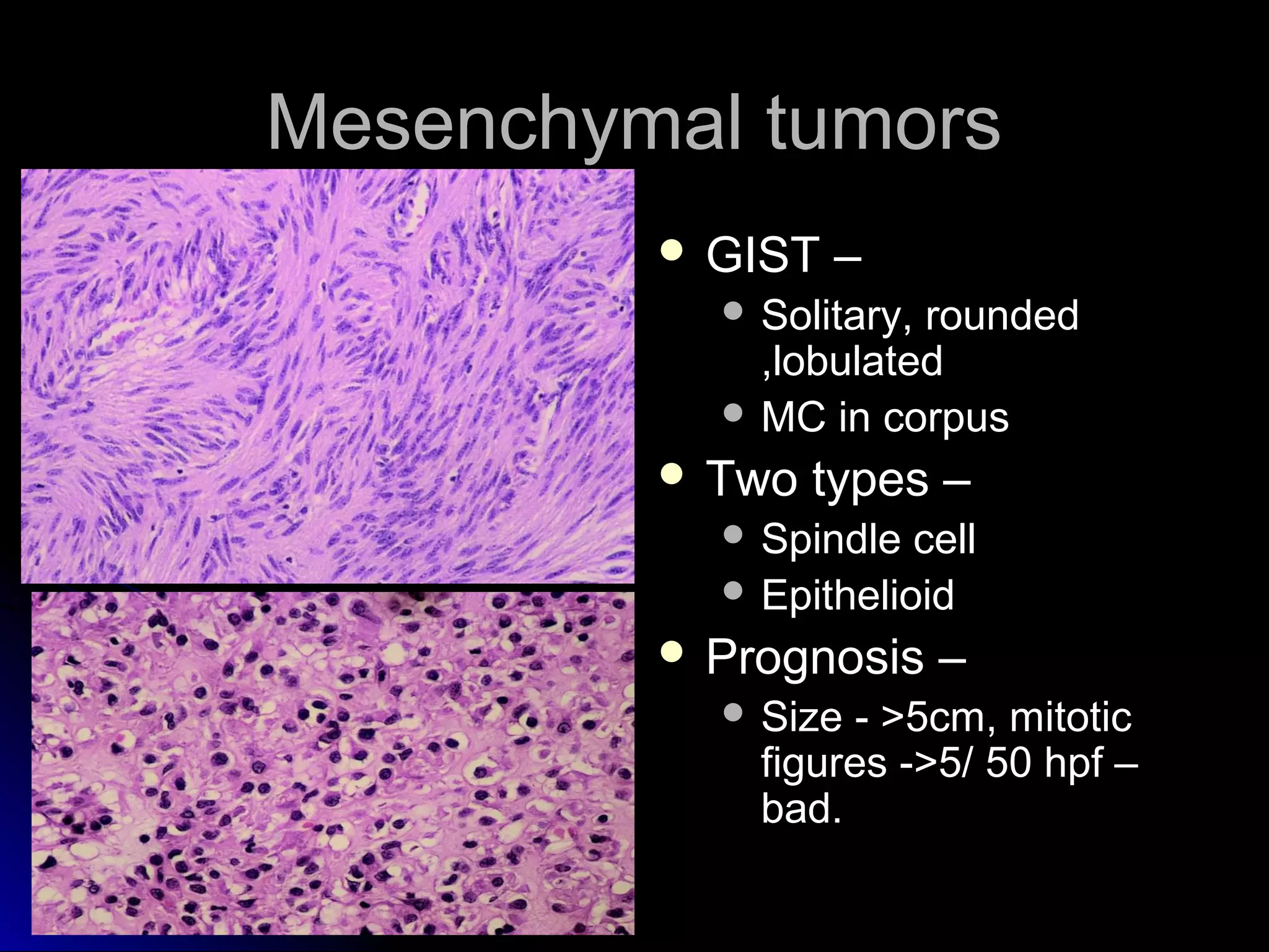 Mesenchymal tumorsMesenchymal tumors
 GIST –GIST –
 Solitary, roundedSolitary, rounded
,lobulated,lobulated
 MC in corpusMC in corpus
 Two types –Two types –
 Spindle cellSpindle cell
 EpithelioidEpithelioid
 Prognosis –Prognosis –
 Size - >5cm, mitoticSize - >5cm, mitotic
figures ->5/ 50 hpf –figures ->5/ 50 hpf –
bad.bad.
 