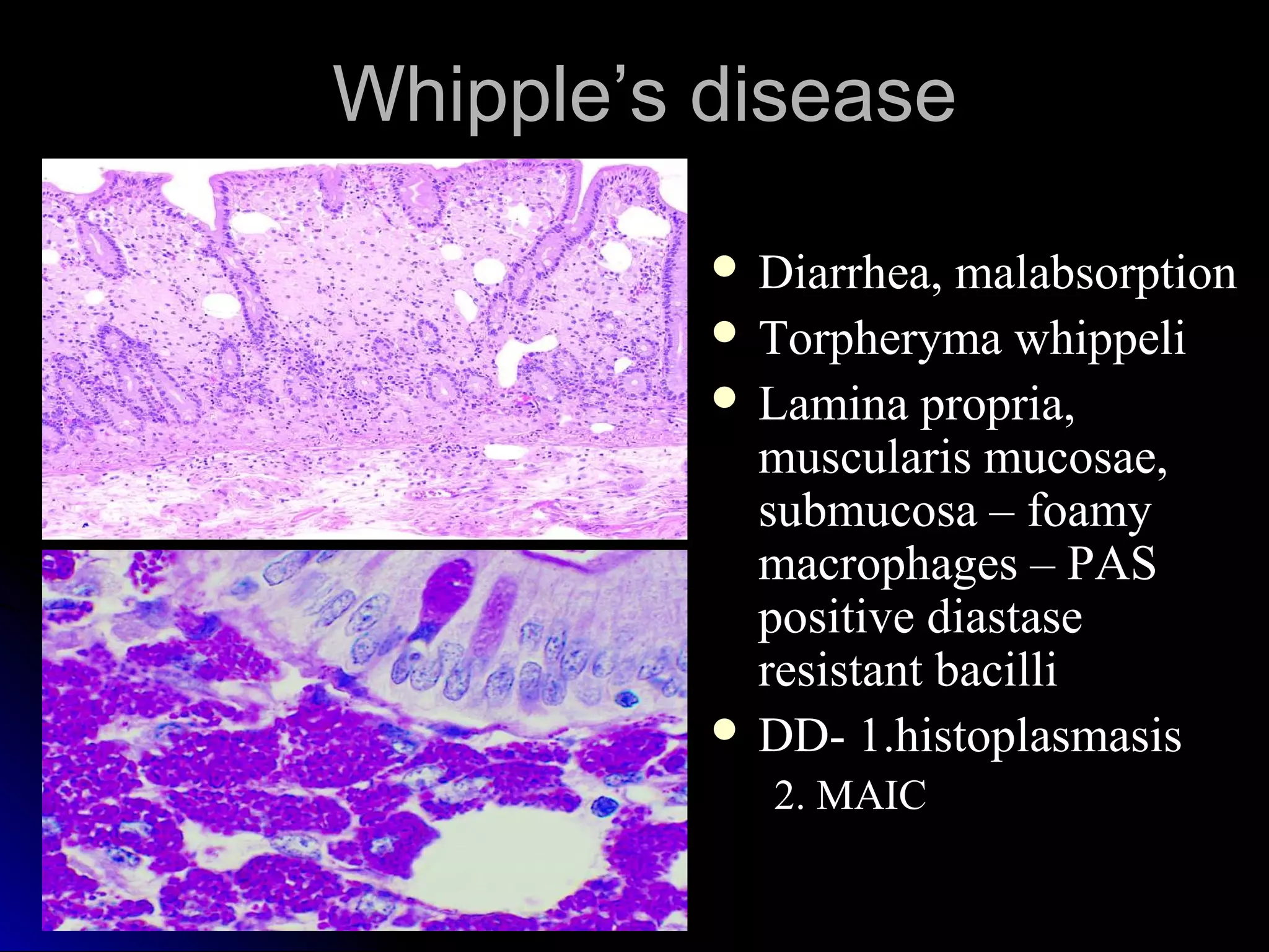 Whipple’s diseaseWhipple’s disease
 Diarrhea, malabsorptionDiarrhea, malabsorption
 Torpheryma whippeliTorpheryma whippeli
 Lamina propria,Lamina propria,
muscularis mucosae,muscularis mucosae,
submucosa – foamysubmucosa – foamy
macrophages – PASmacrophages – PAS
positive diastasepositive diastase
resistant bacilliresistant bacilli
 DD- 1.histoplasmasisDD- 1.histoplasmasis
2. MAIC2. MAIC
 