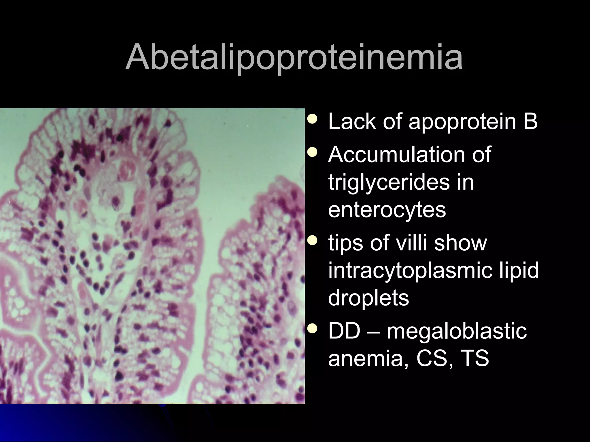 AbetalipoproteinemiaAbetalipoproteinemia
 Lack of apoprotein BLack of apoprotein B
 Accumulation ofAccumulation of
triglycerides intriglycerides in
enterocytesenterocytes
 tips of villi showtips of villi show
intracytoplasmic lipidintracytoplasmic lipid
dropletsdroplets
 DD – megaloblasticDD – megaloblastic
anemia, CS, TSanemia, CS, TS
 