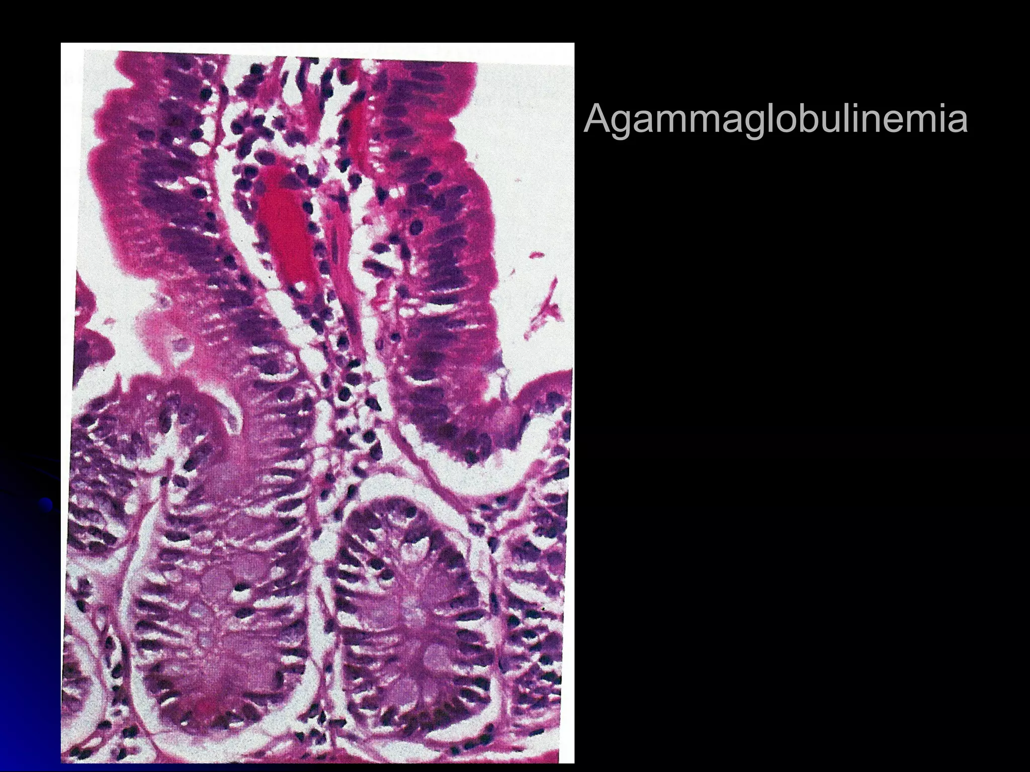 AgammaglobulinemiaAgammaglobulinemia
 