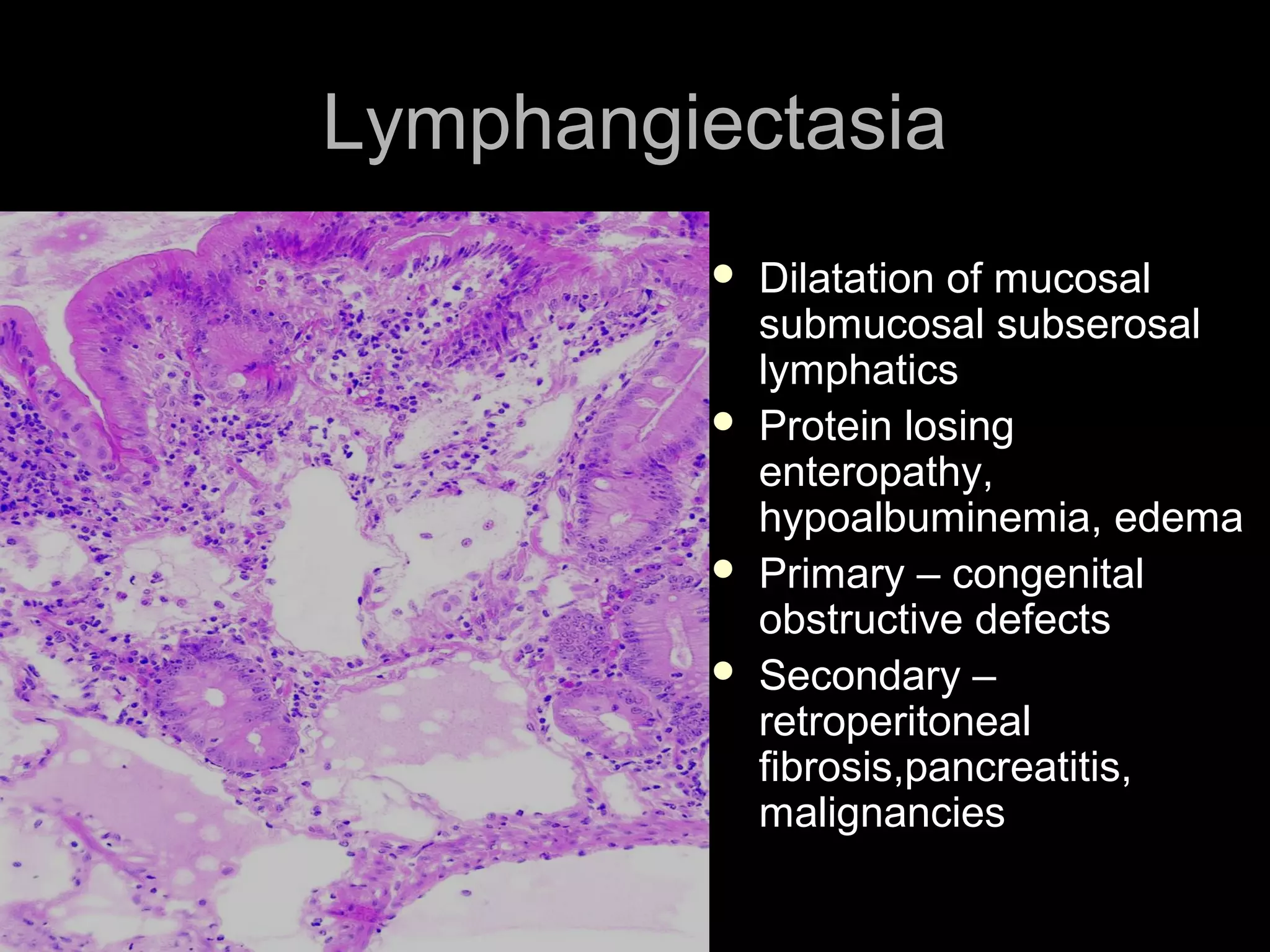 LymphangiectasiaLymphangiectasia
 Dilatation of mucosalDilatation of mucosal
submucosal subserosalsubmucosal subserosal
lymphaticslymphatics
 Protein losingProtein losing
enteropathy,enteropathy,
hypoalbuminemia, edemahypoalbuminemia, edema
 Primary – congenitalPrimary – congenital
obstructive defectsobstructive defects
 Secondary –Secondary –
retroperitonealretroperitoneal
fibrosis,pancreatitis,fibrosis,pancreatitis,
malignanciesmalignancies
 