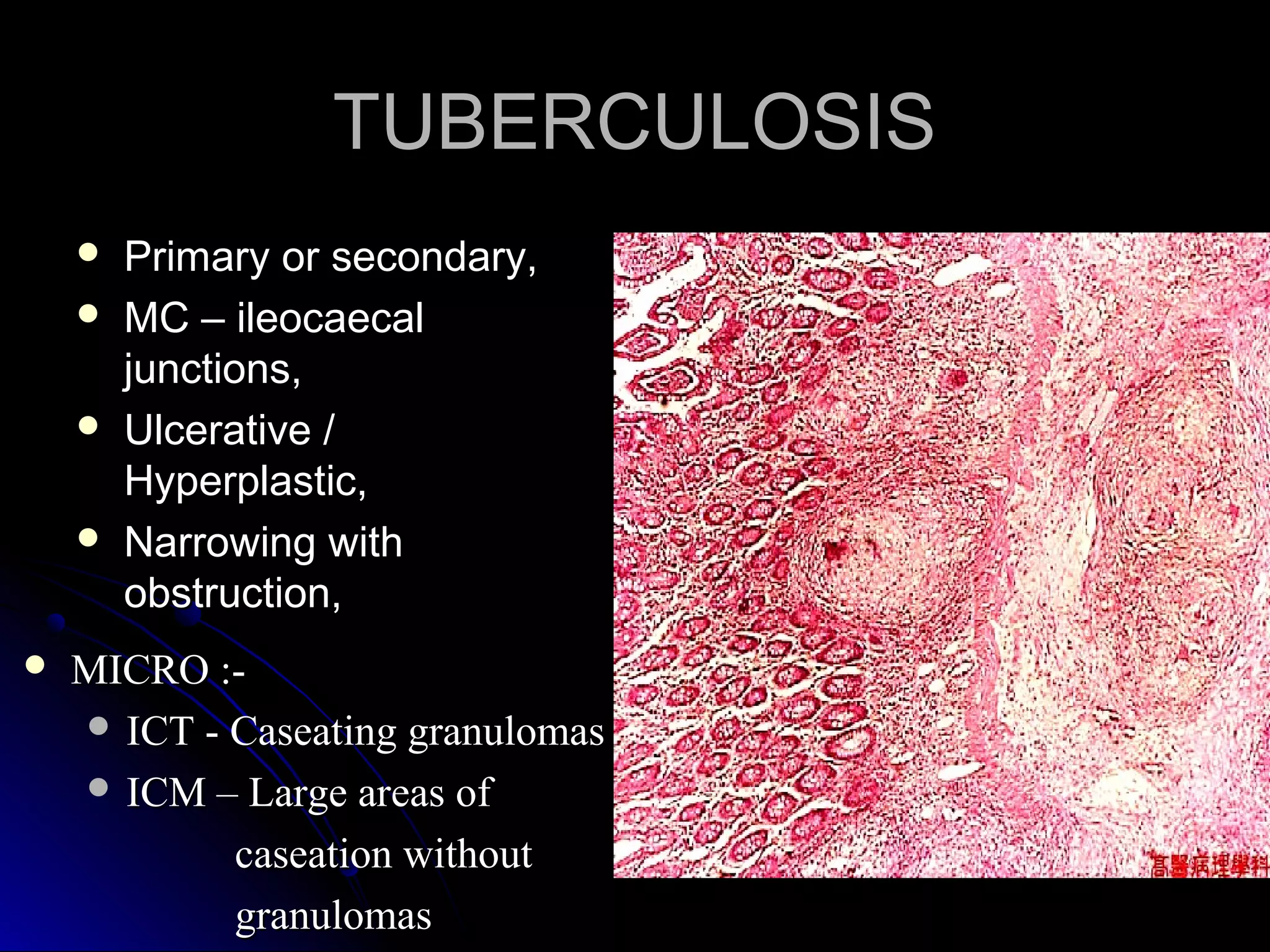 TUBERCULOSISTUBERCULOSIS
 Primary or secondary,Primary or secondary,
 MC – ileocaecalMC – ileocaecal
junctions,junctions,
 Ulcerative /Ulcerative /
Hyperplastic,Hyperplastic,
 Narrowing withNarrowing with
obstruction,obstruction,
 MICRO :-MICRO :-
 ICT - Caseating granulomasICT - Caseating granulomas
 ICM – Large areas ofICM – Large areas of
caseation withoutcaseation without
granulomasgranulomas
 