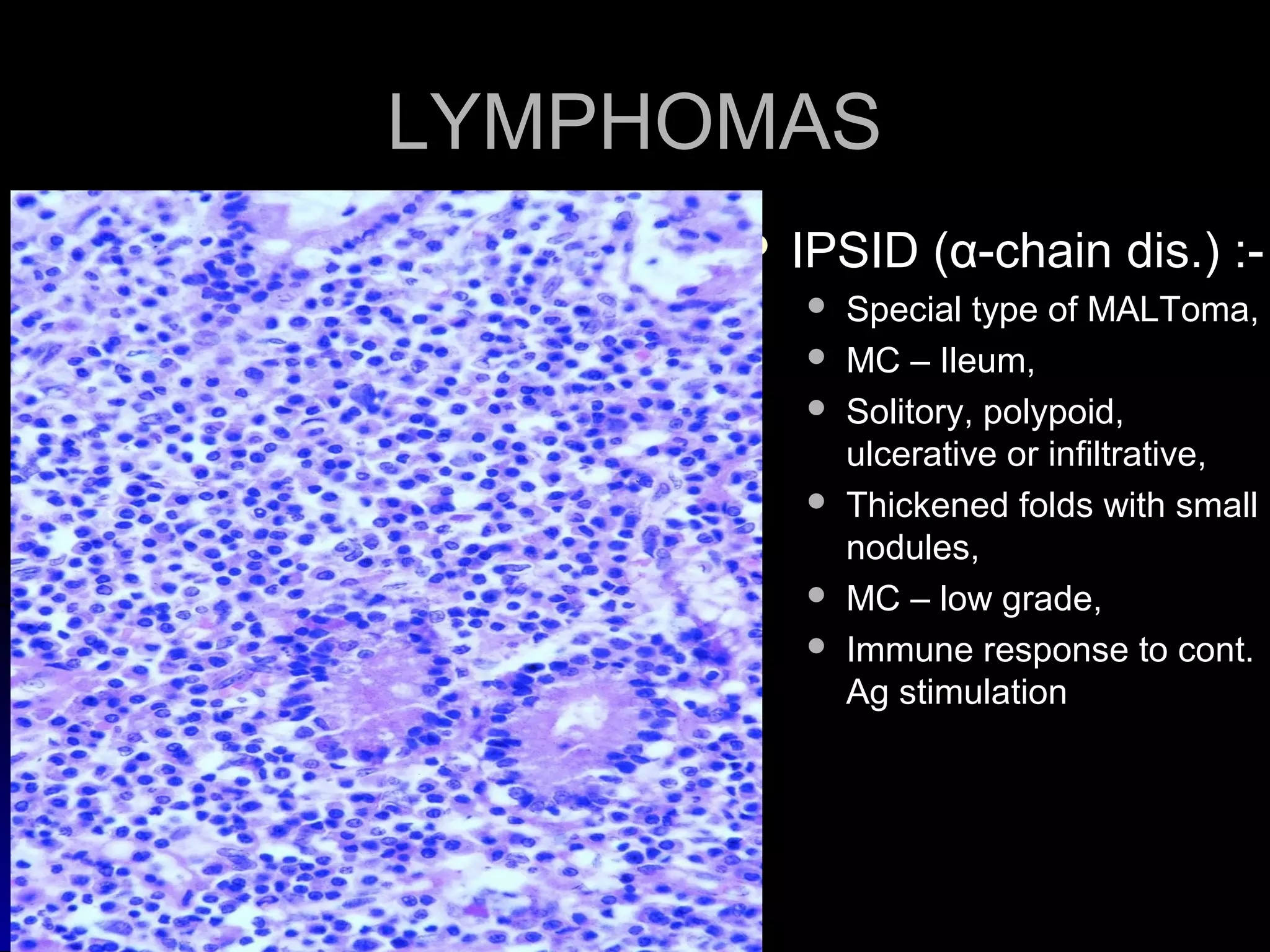 LYMPHOMASLYMPHOMAS
 IPSID (IPSID (αα--chain dis.) :-chain dis.) :-
 Special type of MALToma,Special type of MALToma,
 MC – Ileum,MC – Ileum,
 Solitory, polypoid,Solitory, polypoid,
ulcerative or infiltrative,ulcerative or infiltrative,
 Thickened folds with smallThickened folds with small
nodules,nodules,
 MC – low grade,MC – low grade,
 Immune response to cont.Immune response to cont.
Ag stimulationAg stimulation
 