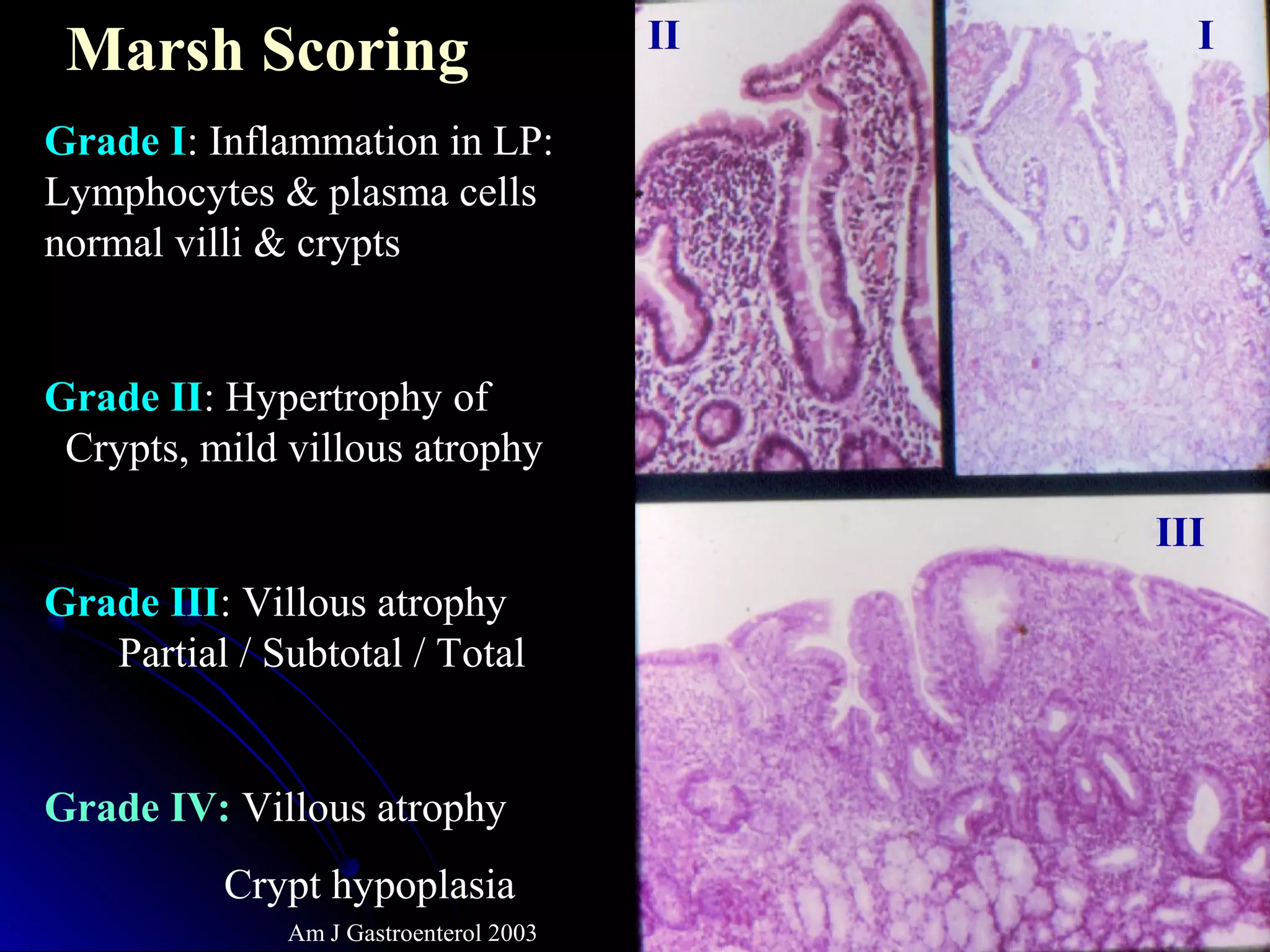 Marsh Scoring
Grade I: Inflammation in LP:
Lymphocytes & plasma cells
normal villi & crypts
Grade II: Hypertrophy of
Crypts, mild villous atrophy
Grade III: Villous atrophy
Partial / Subtotal / Total
Grade IV: Villous atrophy
Crypt hypoplasia
Am J Gastroenterol 2003
III
III
 