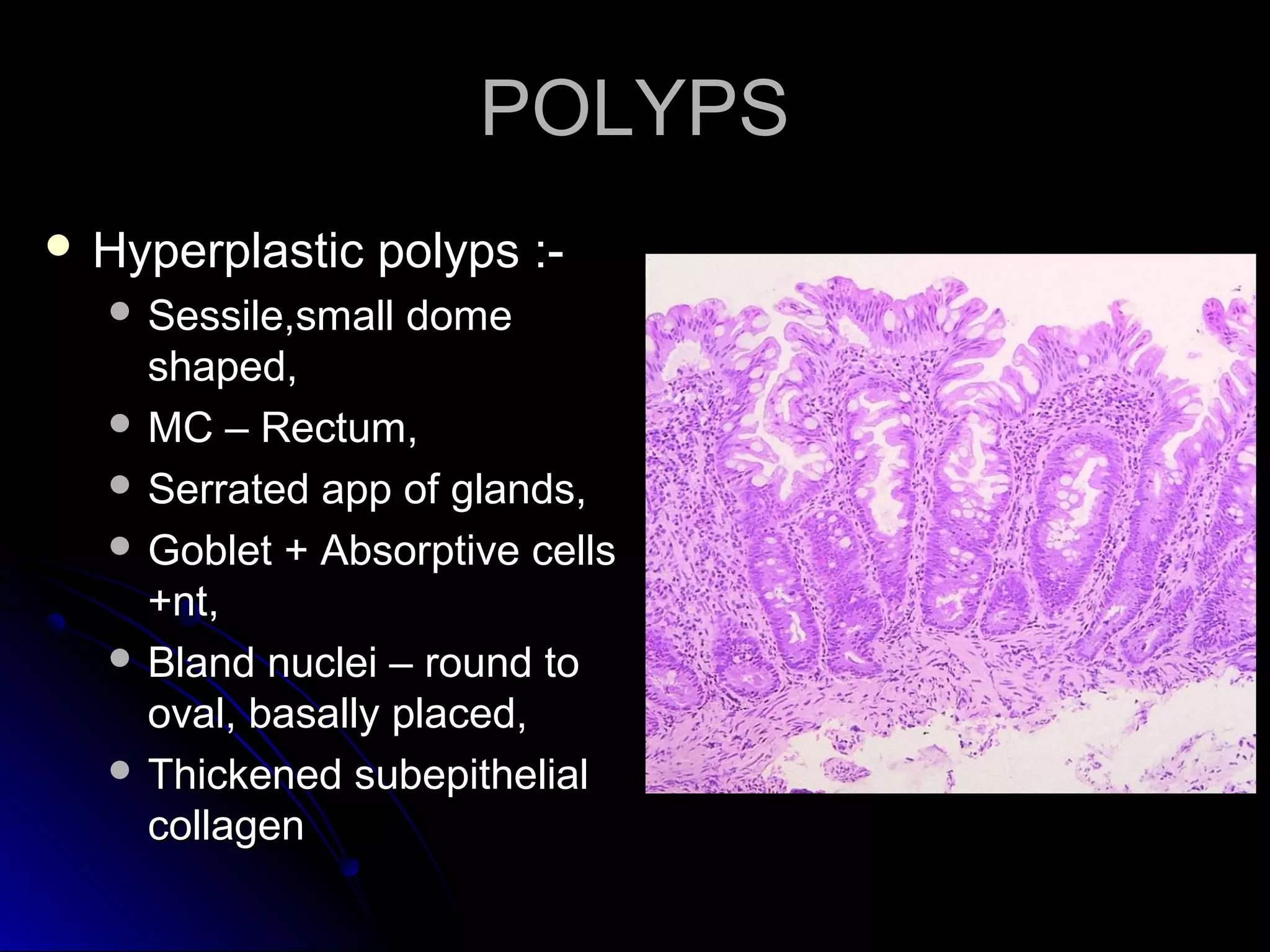 POLYPSPOLYPS
 Hyperplastic polyps :-Hyperplastic polyps :-
 Sessile,small domeSessile,small dome
shaped,shaped,
 MC – Rectum,MC – Rectum,
 Serrated app of glands,Serrated app of glands,
 Goblet + Absorptive cellsGoblet + Absorptive cells
+nt,+nt,
 Bland nuclei – round toBland nuclei – round to
oval, basally placed,oval, basally placed,
 Thickened subepithelialThickened subepithelial
collagencollagen
 