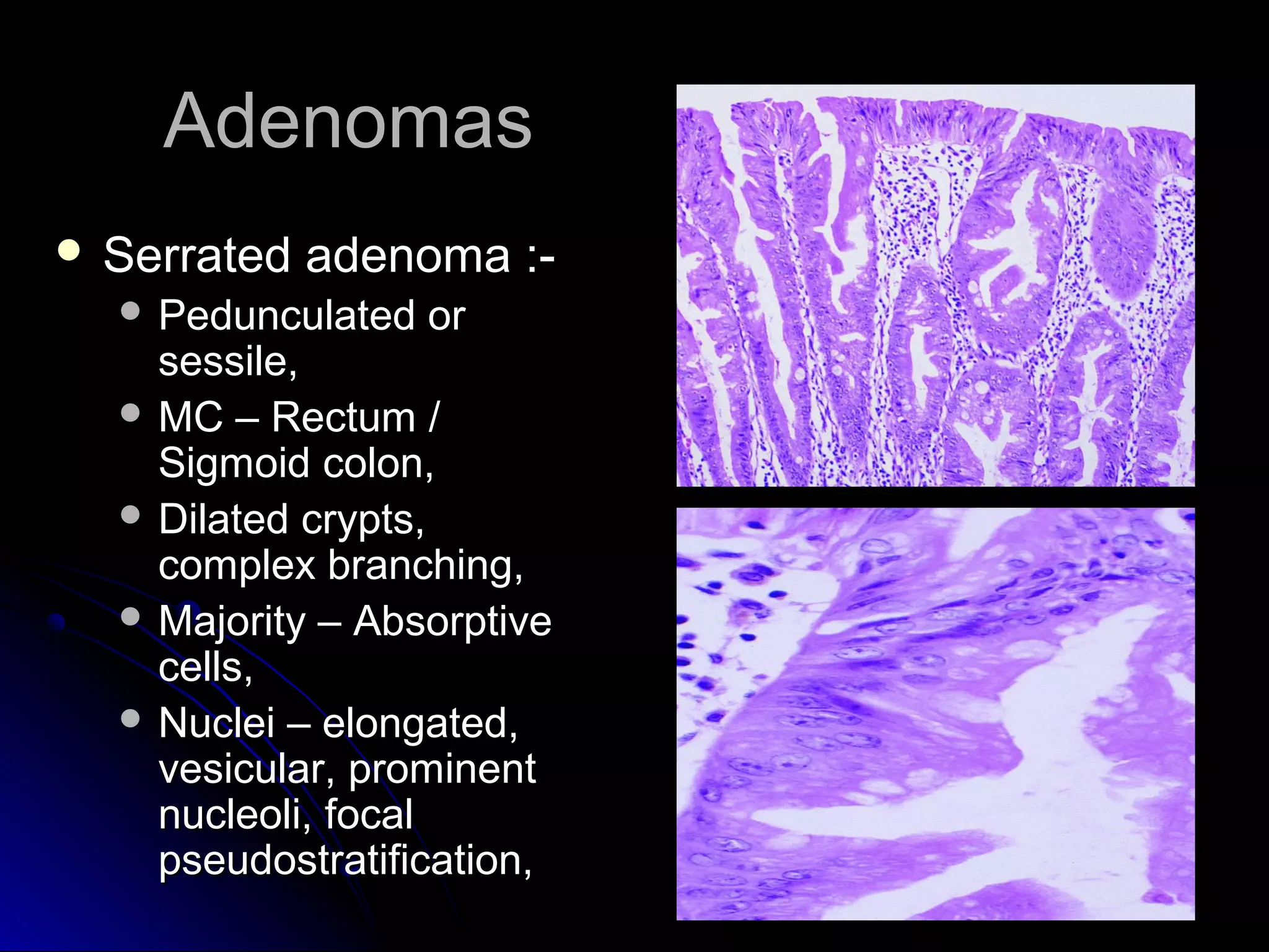 AdenomasAdenomas
 Serrated adenoma :-Serrated adenoma :-
 Pedunculated orPedunculated or
sessile,sessile,
 MC – Rectum /MC – Rectum /
Sigmoid colon,Sigmoid colon,
 Dilated crypts,Dilated crypts,
complex branching,complex branching,
 Majority – AbsorptiveMajority – Absorptive
cells,cells,
 Nuclei – elongated,Nuclei – elongated,
vesicular, prominentvesicular, prominent
nucleoli, focalnucleoli, focal
pseudostratification,pseudostratification,
 