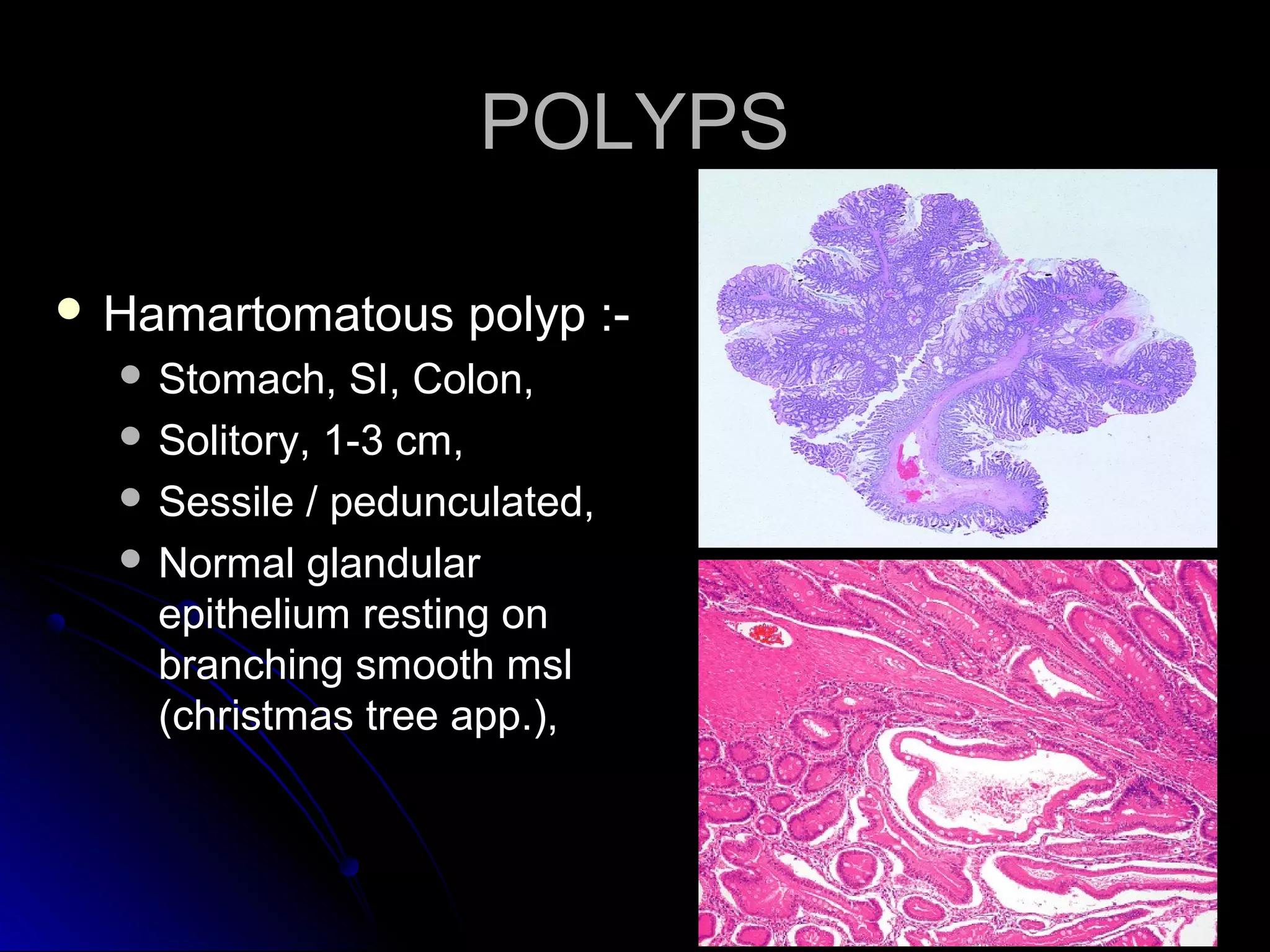 POLYPSPOLYPS
 Hamartomatous polyp :-Hamartomatous polyp :-
 Stomach, SI, Colon,Stomach, SI, Colon,
 Solitory, 1-3 cm,Solitory, 1-3 cm,
 Sessile / pedunculated,Sessile / pedunculated,
 Normal glandularNormal glandular
epithelium resting onepithelium resting on
branching smooth mslbranching smooth msl
(christmas tree app.),(christmas tree app.),
 