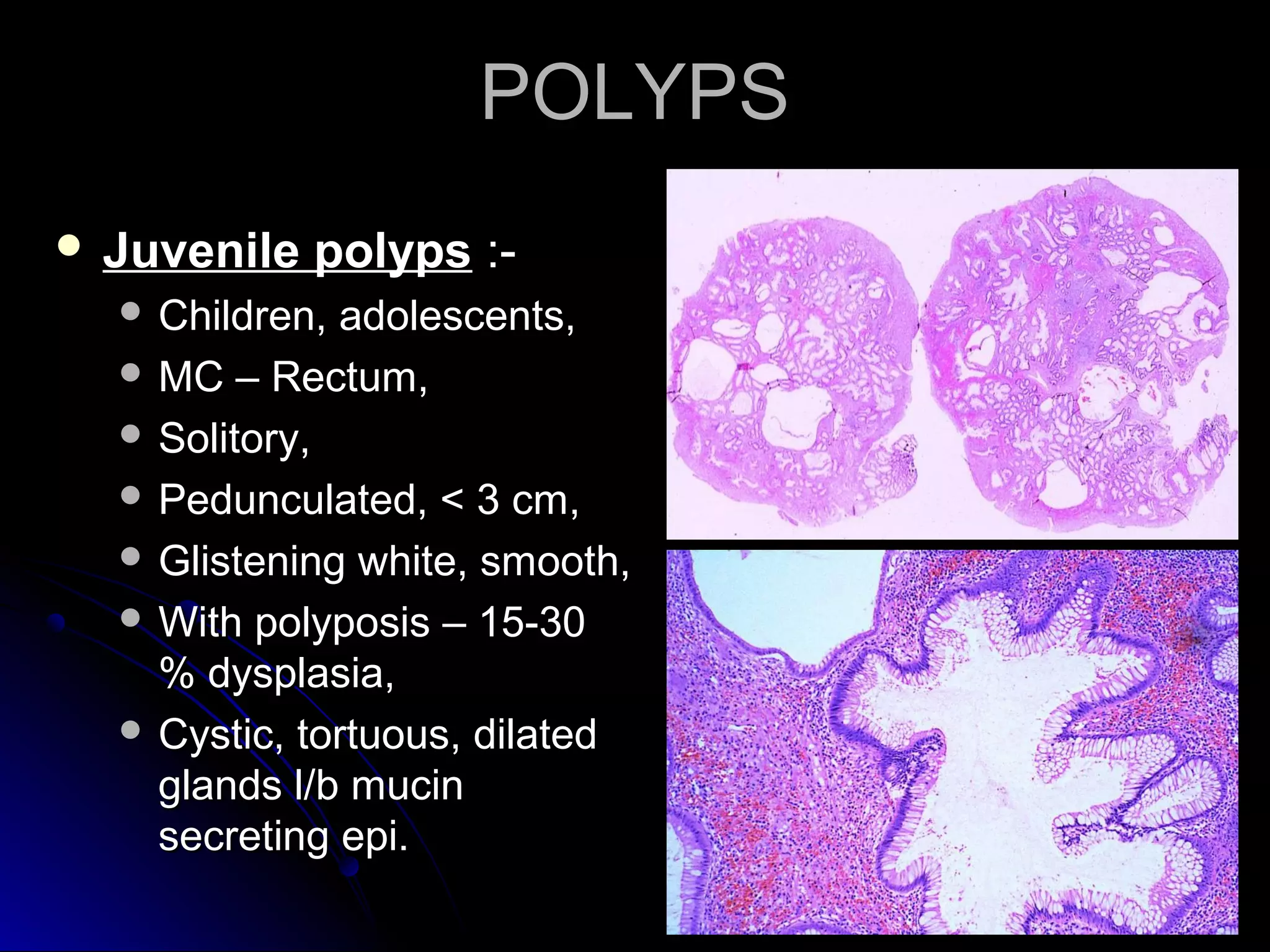 POLYPSPOLYPS
 Juvenile polypsJuvenile polyps :-:-
 Children, adolescents,Children, adolescents,
 MC – Rectum,MC – Rectum,
 Solitory,Solitory,
 Pedunculated, < 3 cm,Pedunculated, < 3 cm,
 Glistening white, smooth,Glistening white, smooth,
 With polyposis – 15-30With polyposis – 15-30
% dysplasia,% dysplasia,
 Cystic, tortuous, dilatedCystic, tortuous, dilated
glands l/b mucinglands l/b mucin
secreting epi.secreting epi.
 