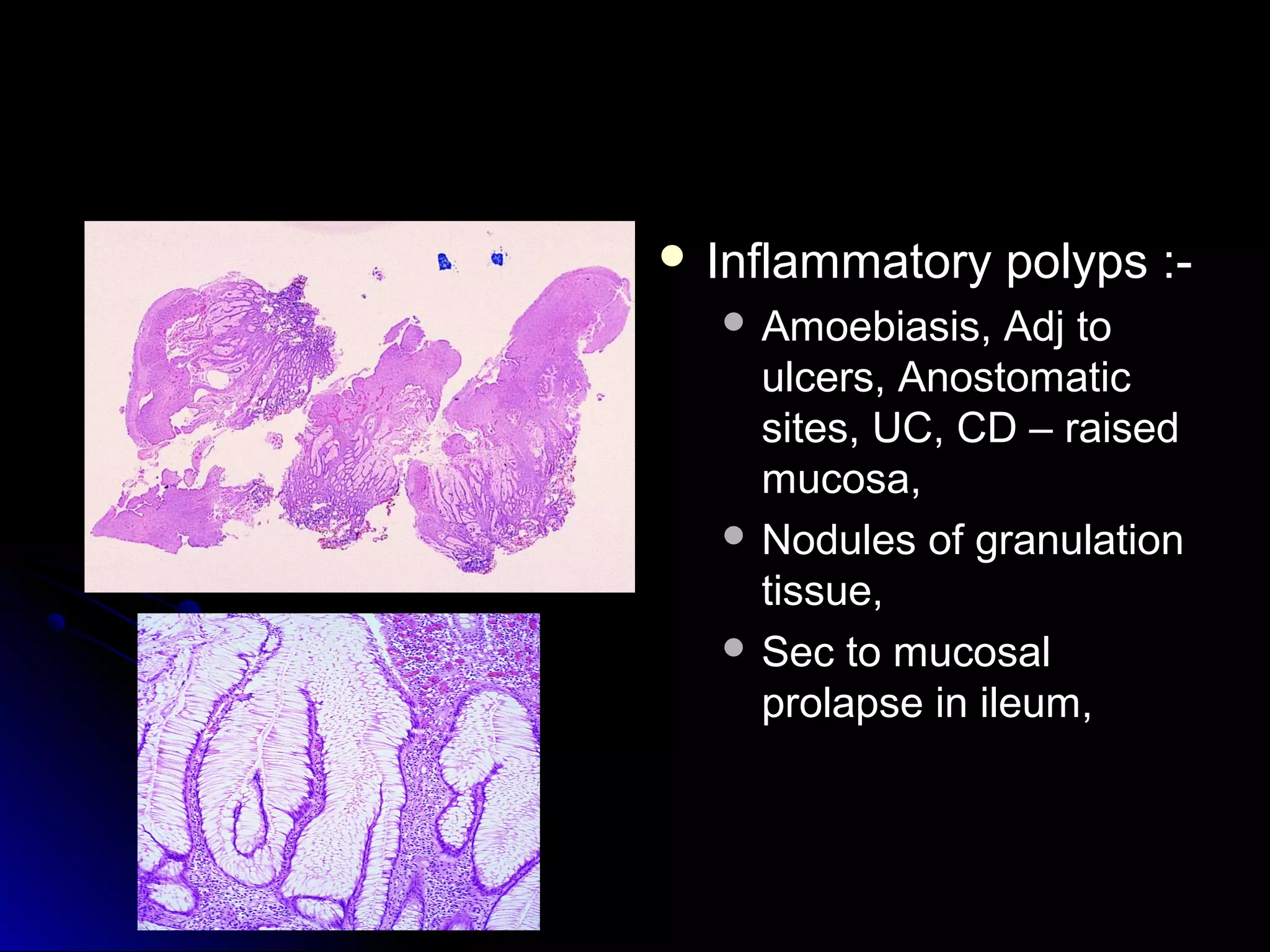  Inflammatory polyps :-Inflammatory polyps :-
 Amoebiasis, Adj toAmoebiasis, Adj to
ulcers, Anostomaticulcers, Anostomatic
sites, UC, CD – raisedsites, UC, CD – raised
mucosa,mucosa,
 Nodules of granulationNodules of granulation
tissue,tissue,
 Sec to mucosalSec to mucosal
prolapse in ileum,prolapse in ileum,
 