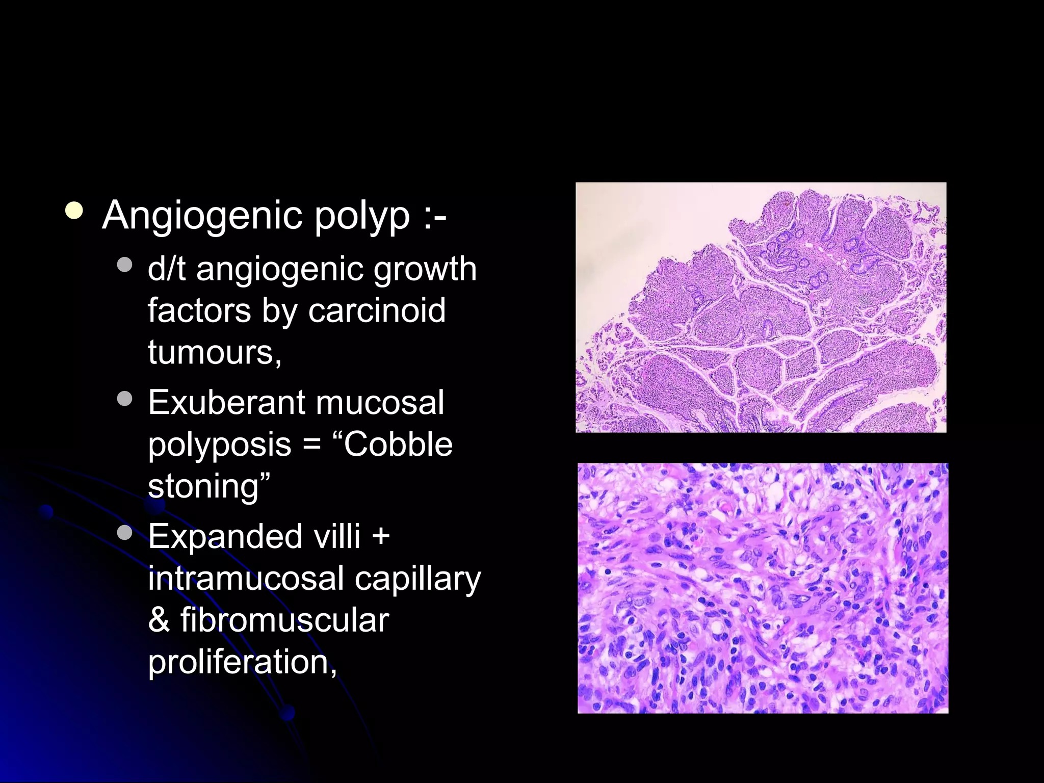  Angiogenic polyp :-Angiogenic polyp :-
 d/t angiogenic growthd/t angiogenic growth
factors by carcinoidfactors by carcinoid
tumours,tumours,
 Exuberant mucosalExuberant mucosal
polyposis = “Cobblepolyposis = “Cobble
stoning”stoning”
 Expanded villi +Expanded villi +
intramucosal capillaryintramucosal capillary
& fibromuscular& fibromuscular
proliferation,proliferation,
 
