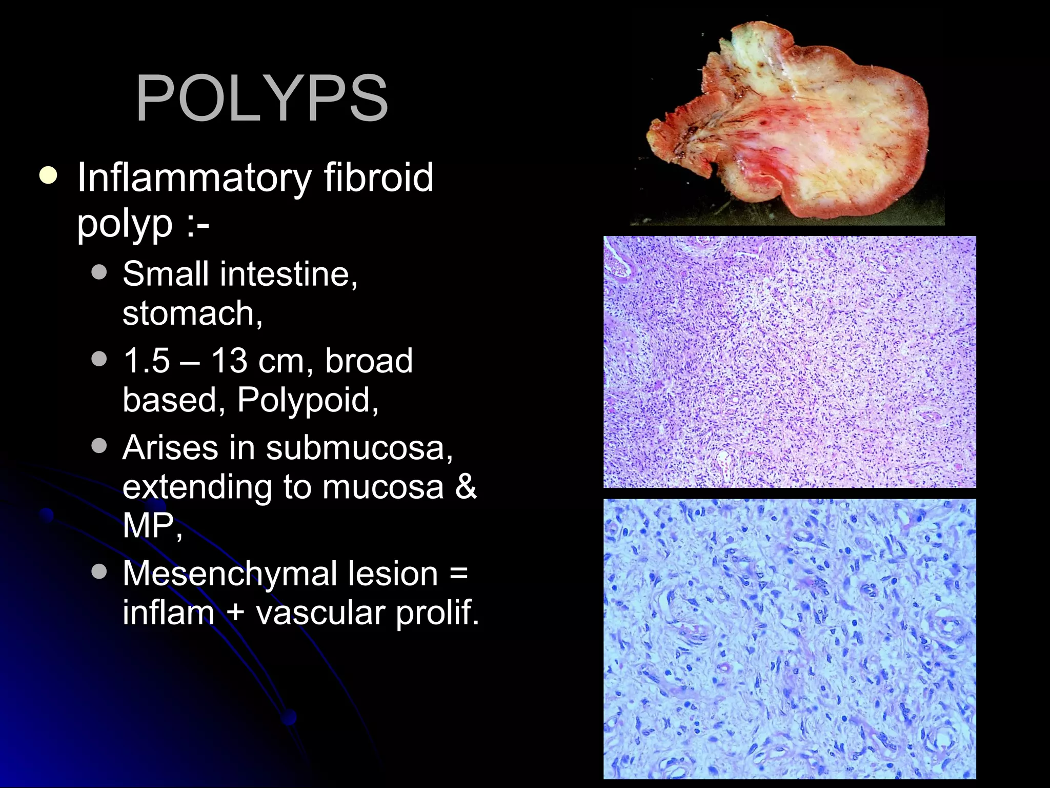 POLYPSPOLYPS
 Inflammatory fibroidInflammatory fibroid
polyp :-polyp :-
 Small intestine,Small intestine,
stomach,stomach,
 1.5 – 13 cm, broad1.5 – 13 cm, broad
based, Polypoid,based, Polypoid,
 Arises in submucosa,Arises in submucosa,
extending to mucosa &extending to mucosa &
MP,MP,
 Mesenchymal lesion =Mesenchymal lesion =
inflam + vascular prolif.inflam + vascular prolif.
 
