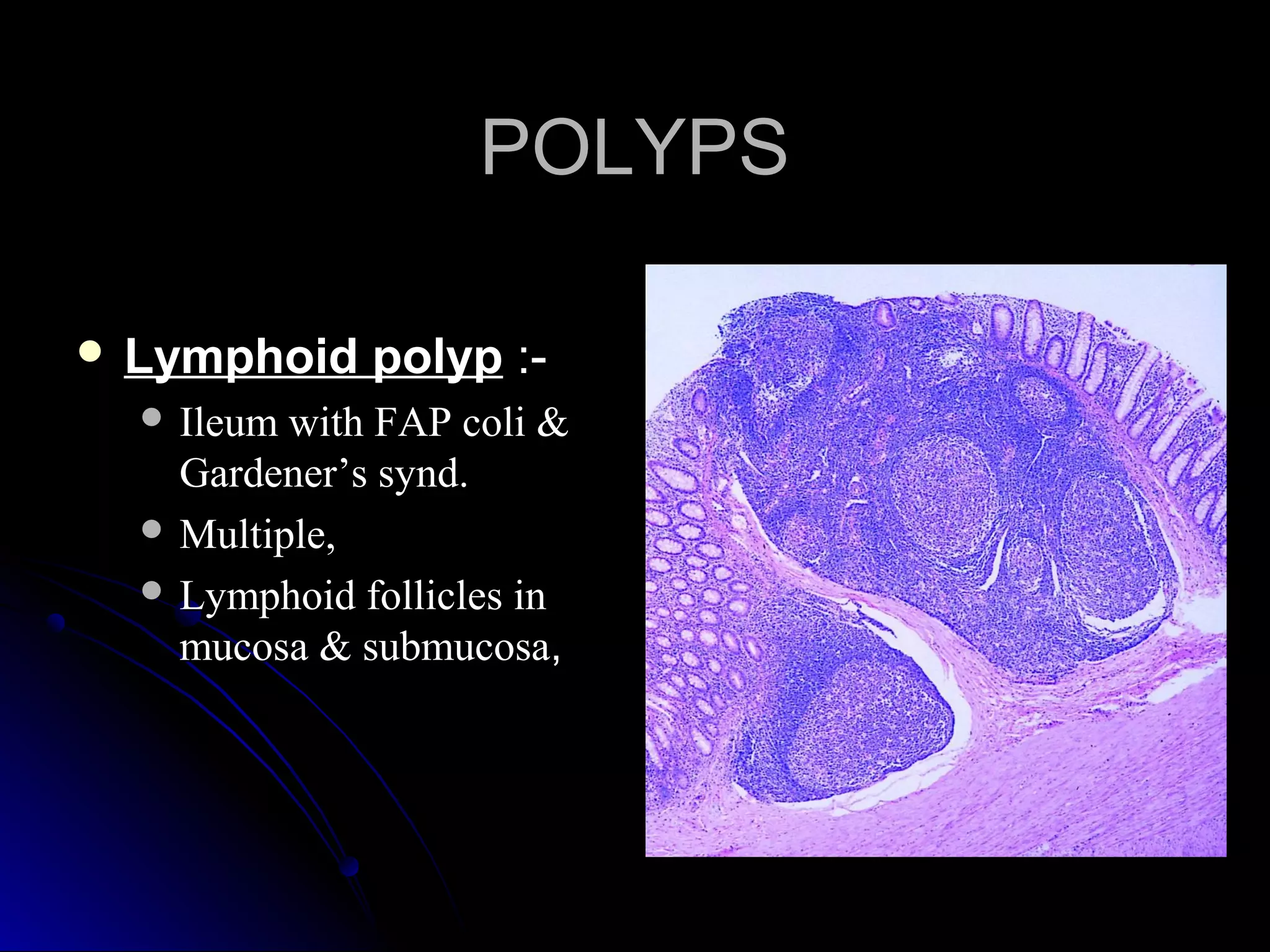 POLYPSPOLYPS
 Lymphoid polypLymphoid polyp :-:-
 Ileum with FAP coli &Ileum with FAP coli &
Gardener’s synd.Gardener’s synd.
 Multiple,Multiple,
 Lymphoid follicles inLymphoid follicles in
mucosa & submucosamucosa & submucosa,,
 