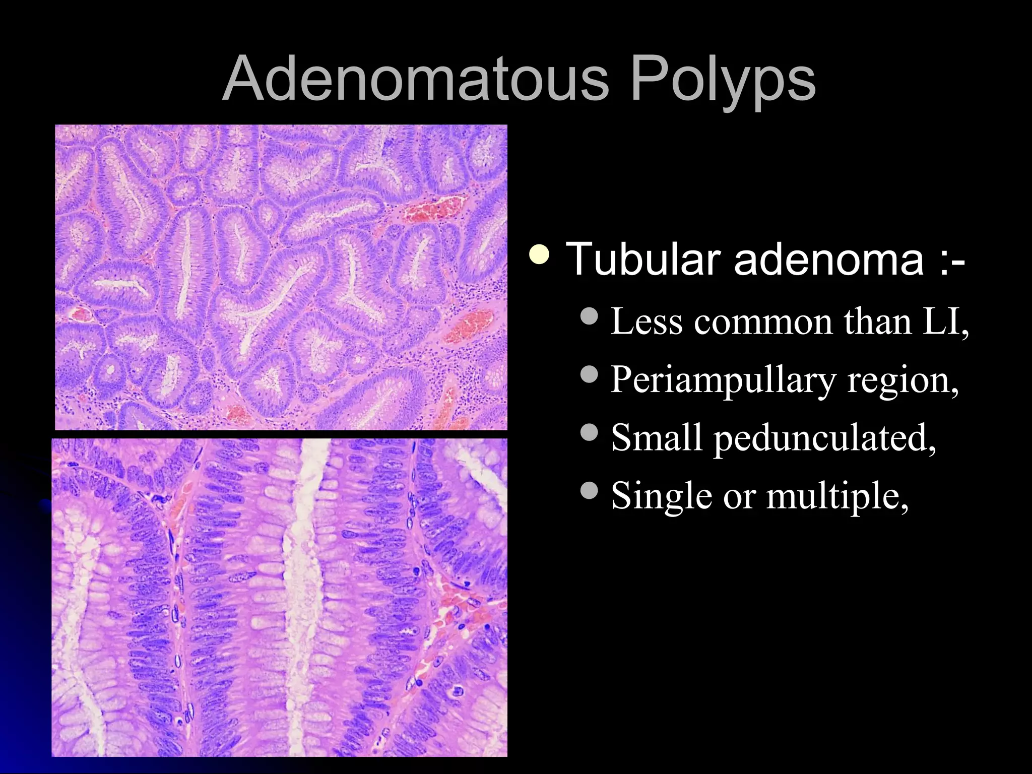 Adenomatous PolypsAdenomatous Polyps
 Tubular adenoma :-Tubular adenoma :-
Less common than LI,Less common than LI,
Periampullary region,Periampullary region,
Small pedunculated,Small pedunculated,
Single or multiple,Single or multiple,
 