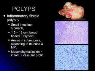Polypoidal Polyp Example Interpretation of endoscopic gastrointestinal biopsy | PPT