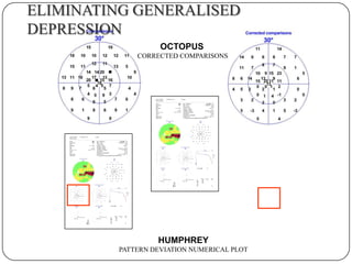 ELIMINATING GENERALISED
DEPRESSION
OCTOPUS
CORRECTED COMPARISONS

HUMPHREY
PATTERN DEVIATION NUMERICAL PLOT

 