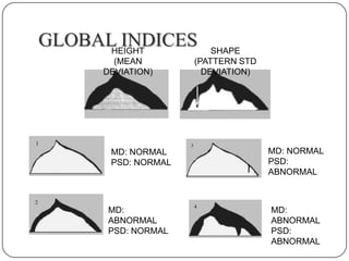 GLOBAL INDICES
HEIGHT
(MEAN
DEVIATION)

MD: NORMAL
PSD: NORMAL

MD:
ABNORMAL
PSD: NORMAL

SHAPE
(PATTERN STD
DEVIATION)

MD: NORMAL
PSD:
ABNORMAL

MD:
ABNORMAL
PSD:
ABNORMAL

 