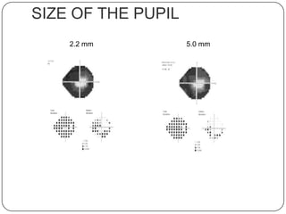 SIZE OF THE PUPIL
2.2 mm

5.0 mm

 