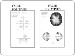 FALSE
POSITIVES

FALSE
NEGATIVES

 