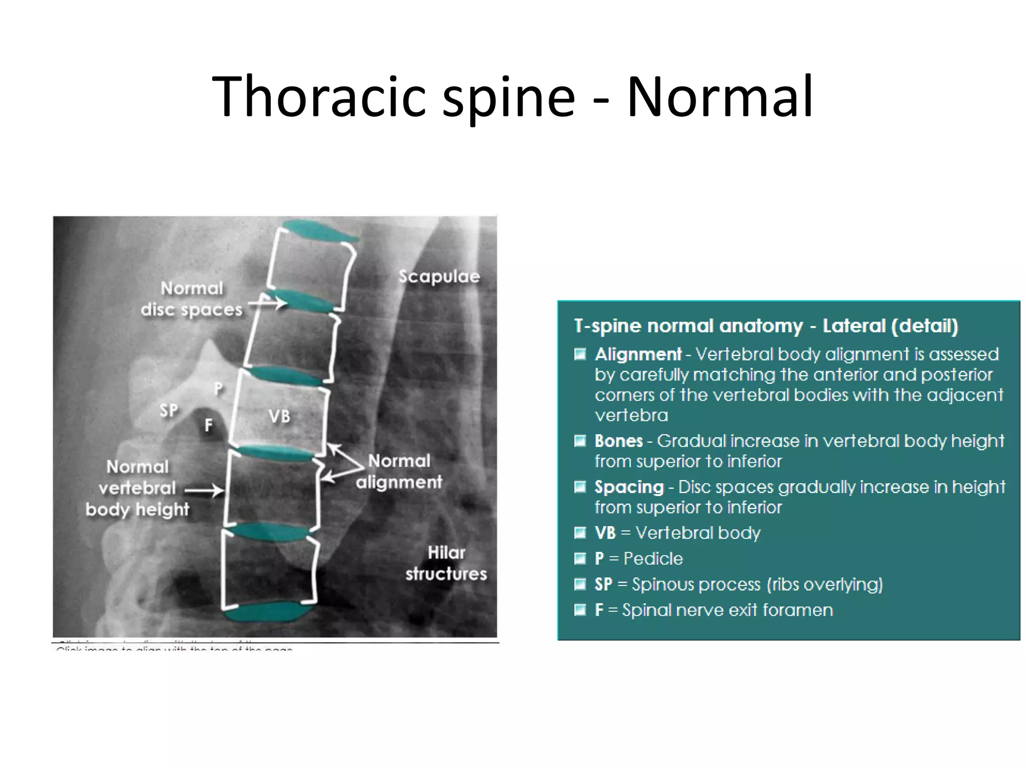 Thoracic Rotation Normal Interpretation of musculoskeletal x rays | PPTX